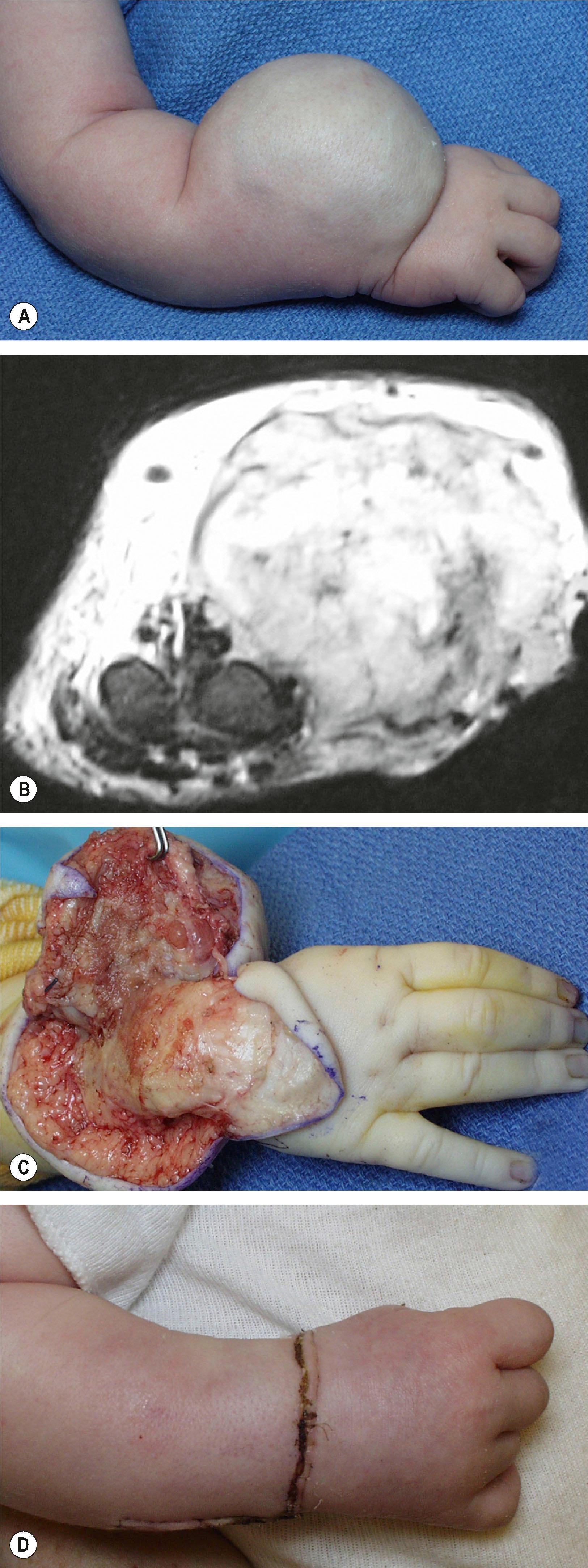 Figure 37.1, Infantile hemangioma (IH). (A) This well-localized, solitary IH on the dorsal forearm has a bluish hue. (B) The MRI shows a multilobular, isointense lesion on T 2 -weighted images. (C) Excision included extensive dorsal tenosynovectomy. (D) Two weeks later active extension is initiated. Note the current first-line agent for systemic treatment of infantile hemangioma is oral propranolol. Surgery is reserved for non-responsive or noninvoluting lesions, or those that threaten function.