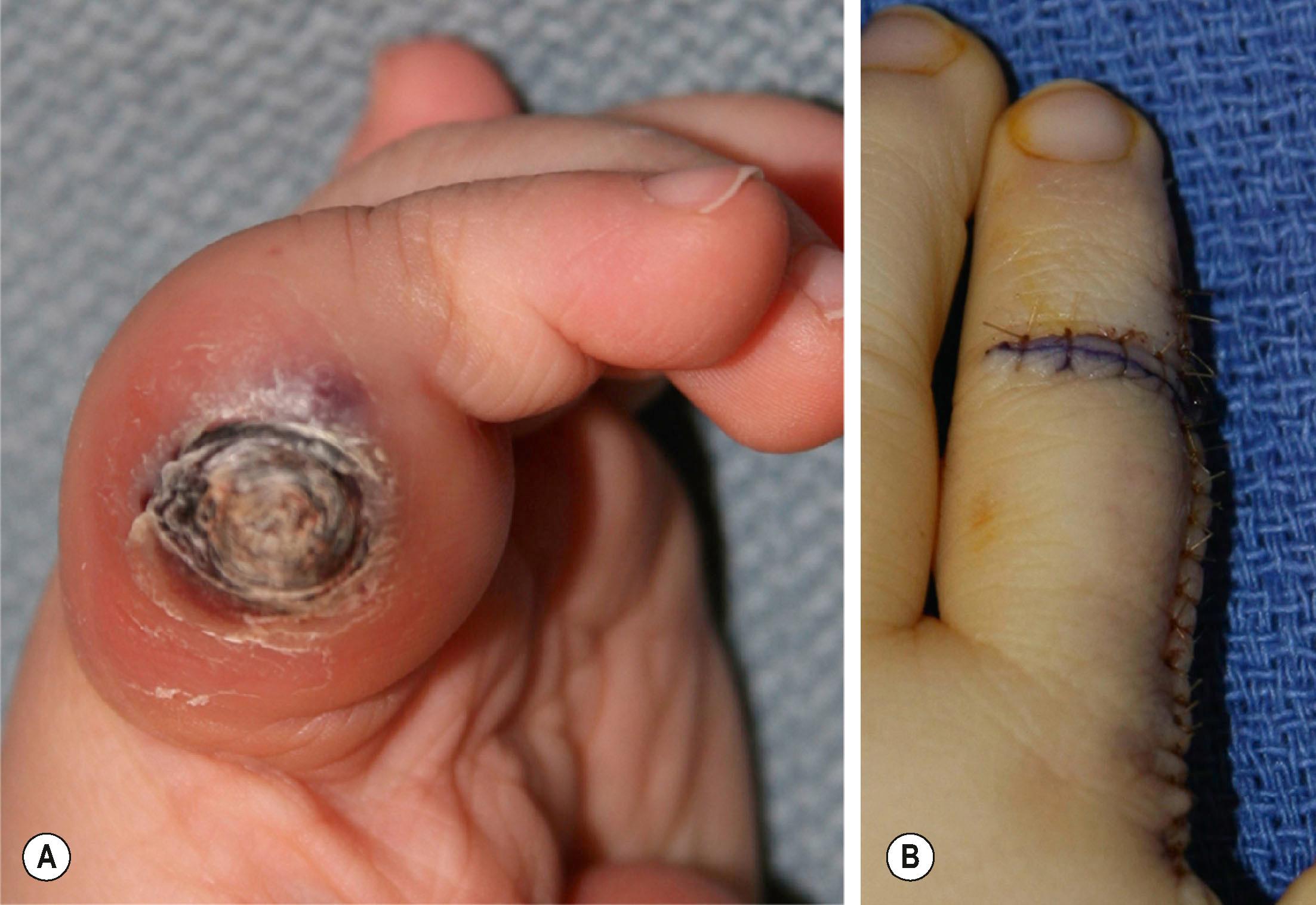 Figure 37.2, Infantile hemangioma (IH). (A) An expanding IH with chronic ulceration and bleeding in a 9-month-old child. (B) Excision was performed through a high mid-axial incision and existing skin creases.