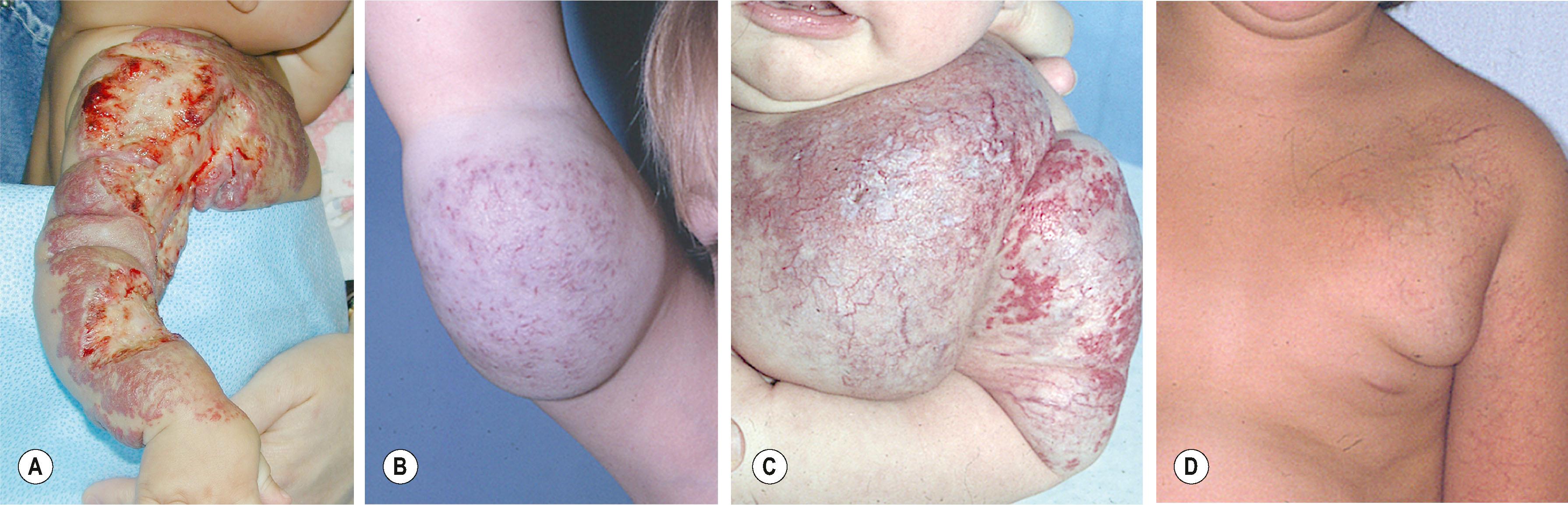 Figure 37.3, Congenital hemangioma (CH). (A) Extensive skin ulceration may occur during proliferation and involution, requiring local wound care. (B) A NICH shows coarse telangiectasia and hard nodules surrounded by a peripheral halo. (C) A RICH shows typical enlargement and coarse telangiectasia during infancy before rapidly involuting. (D ) Several years later with no treatment.