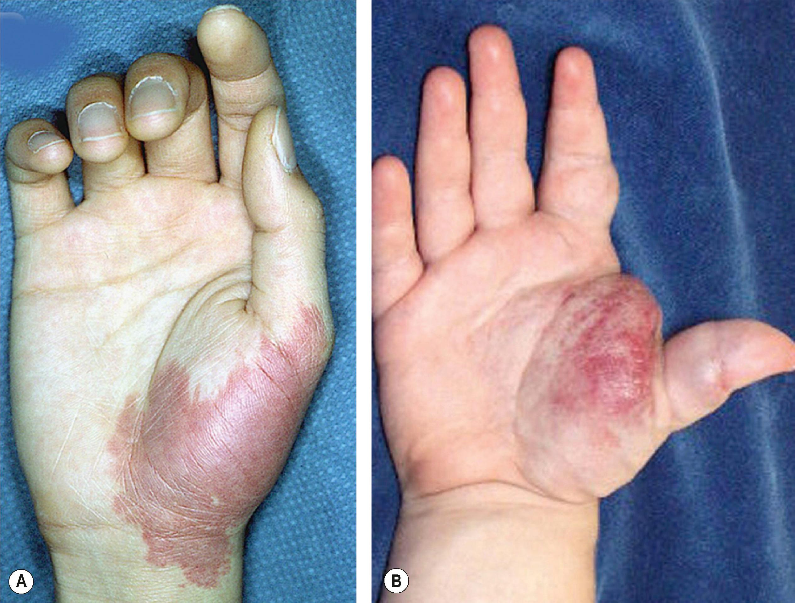 Figure 37.5, Variations of capillary malformation (CM). (A) Solitary CM over the thenar region in a teenager; stain darkened during the adolescent growth spurt. (B) Localized CM plus large underlying arteriovenous malformation (CM–AVM) and a palpable thrill.