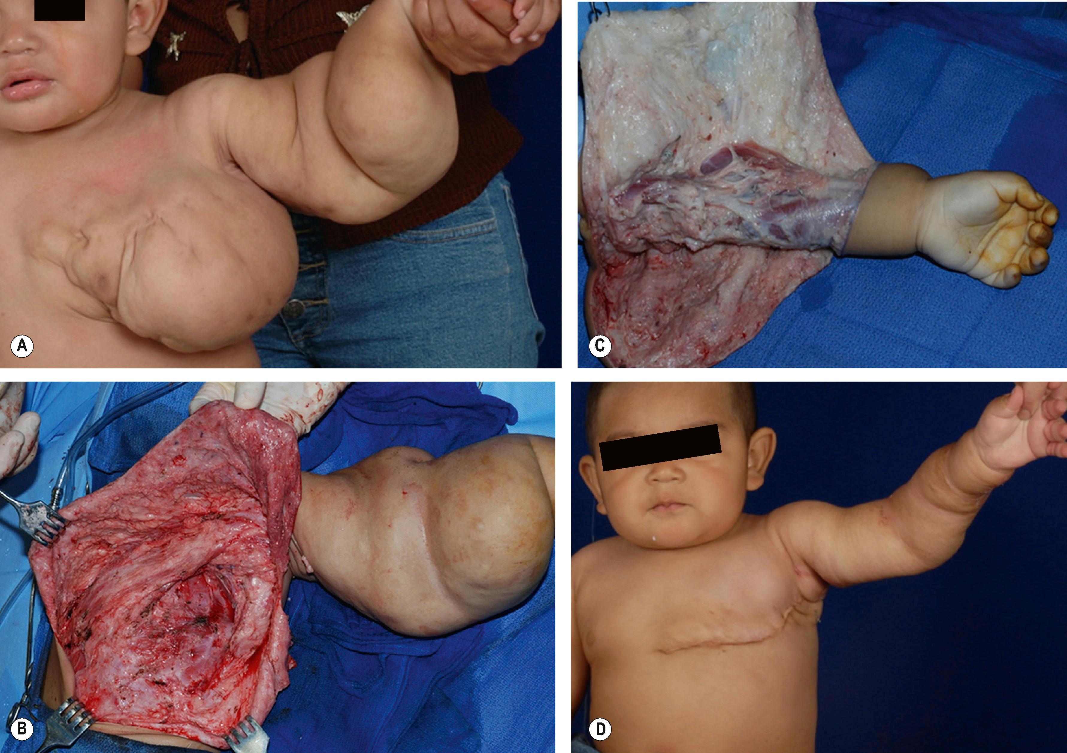 Figure 37.6, Chest wall and forearm LM. (A) Rubbery, firm LM involving the entire arm and chest wall with a normal hand in a 16-month child. (B,C) Staged resections started with the chest wall where pectoralis major, latissimus dorsi, and serratus anterior muscles were preserved. The forearm was debulked in two additional stages. (D) Three months postoperatively.