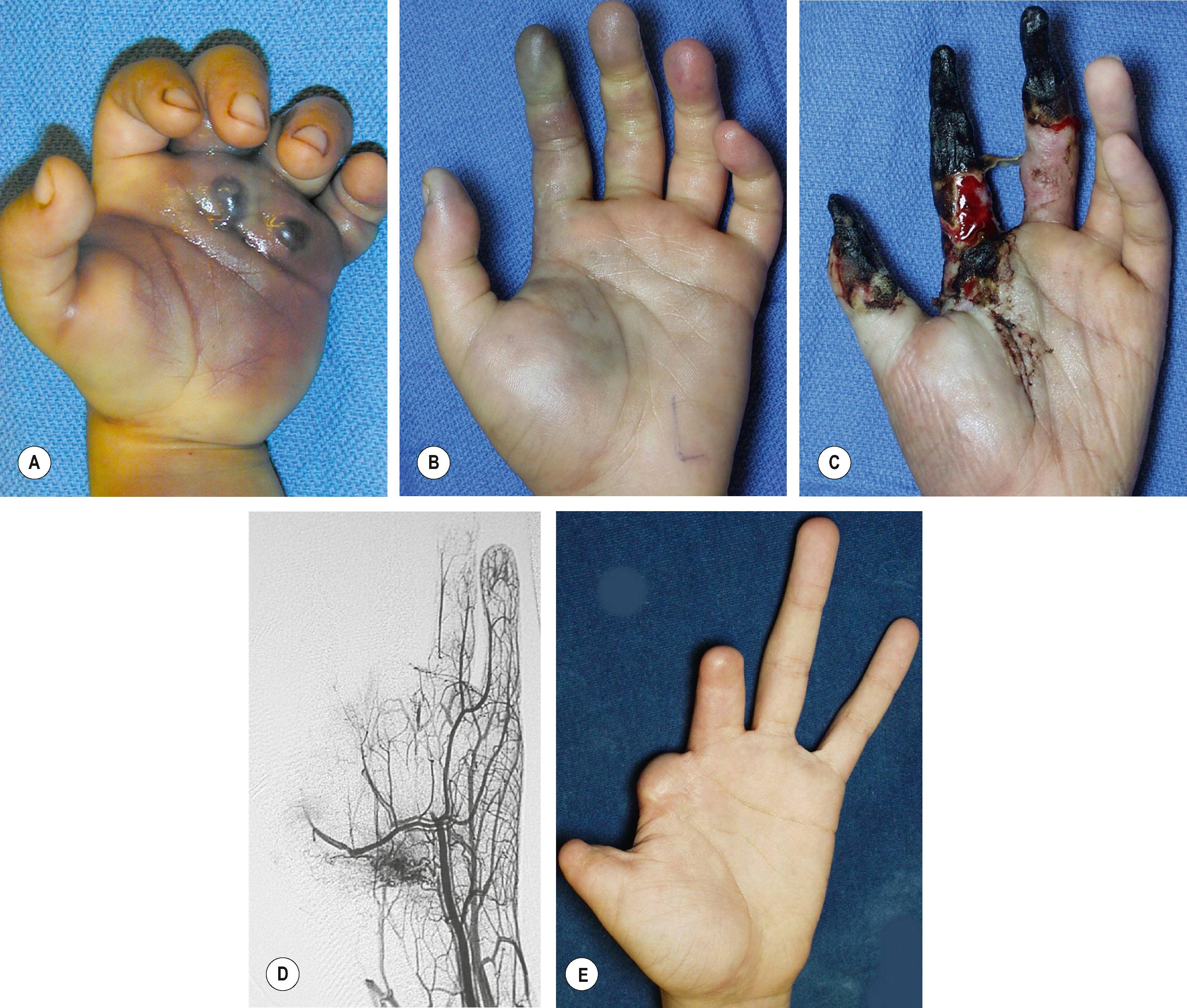 Figure 37.9, Complications of minimally invasive treatment. (A) Intrinsic compartment releases were necessary following sclerosis of this diffuse VM of the entire palm of the hand. (B–E) Ethanol was used to embolize this AVM with a nidus within the palm. The distal portions of the thumb, index, and long digits were lost.