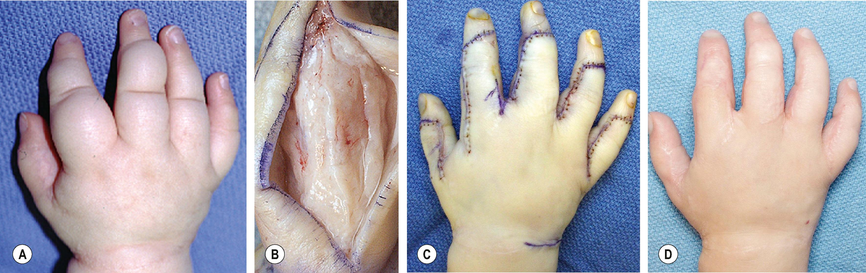 Figure 37.7, Dorsal hand LM. (A) A 4-year-old child presented with an extensive microcystic LM of the hand. The dorsum was approached through an ulnar incision with preservation of the dorsal venous system, nerves, and extensor tendons. (B) The LM along the digits is microcystic, indurated, and envelops all structures without involving the joint spaces. (C) Multiple digits are debulked in a single stage. (D) With continued compression wrapping and exercise, contour and function have been maintained long term.