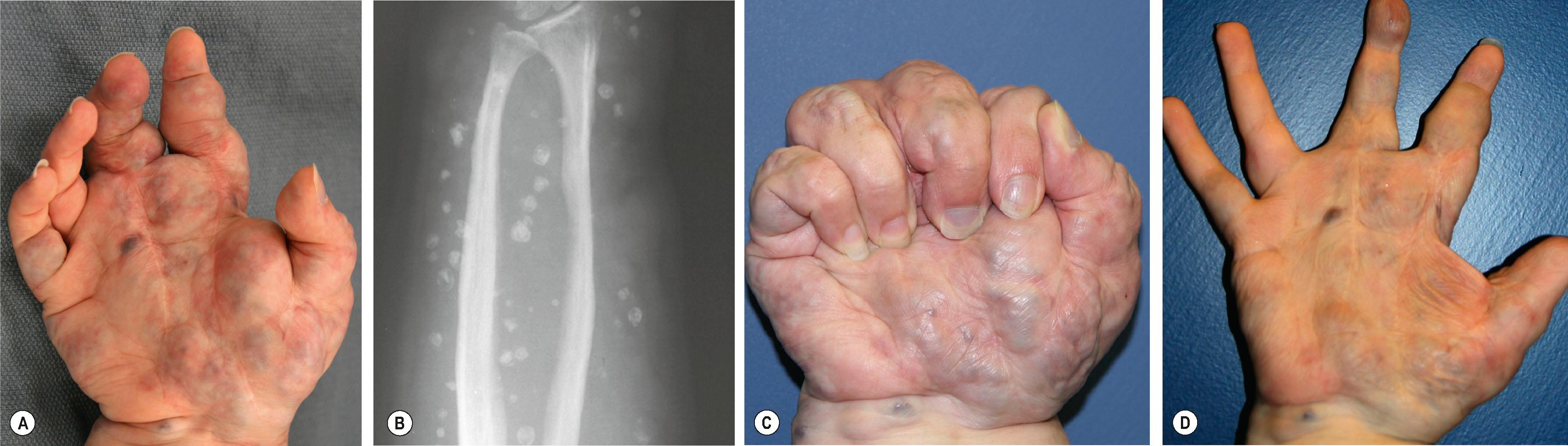 Figure 37.8, Diffuse VM of the hand and forearm. (A) In a dependent position, the hand becomes engorged; bulk and weight become a functional impediment. (B) Calcified phleboliths are often present. (C) Functional motion is impaired only by local bulk of the malformation. (D) After elevation there is no pain, fullness or congestion. This patient is on long-term anticoagulation due to an extensive VM involving the entire extremity and hemi-thorax with a large, stagnant venous collecting system in the axilla.