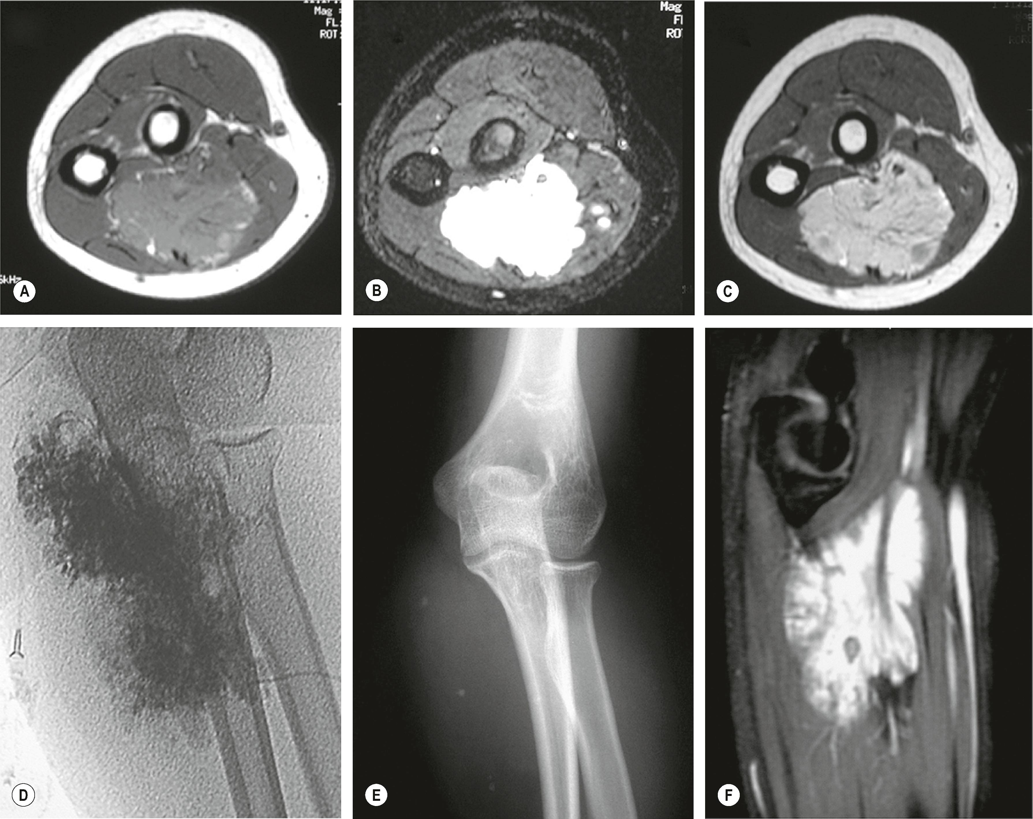 Figure 37.10, Sclerotherapy of VM in the forearm. Radiographic studies of the vulnerable proximal third of the forearm show a VM, which is ideal for sclerotherapy: (A) isointense to adjacent skeletal muscle on axial MRI T 1 -sequence; (B) enhancing on axial MRI T 1 plus gadolinium contrast; (C) showing signal voids on axial MRI T 2 representing phleboliths; (D) filling with direct puncture and injection of contrast; (E) displaying small calcified phleboliths on radiographs; (F) exhibiting multilobulated structure with signal voids on sagittal MRI T 2 sequence.