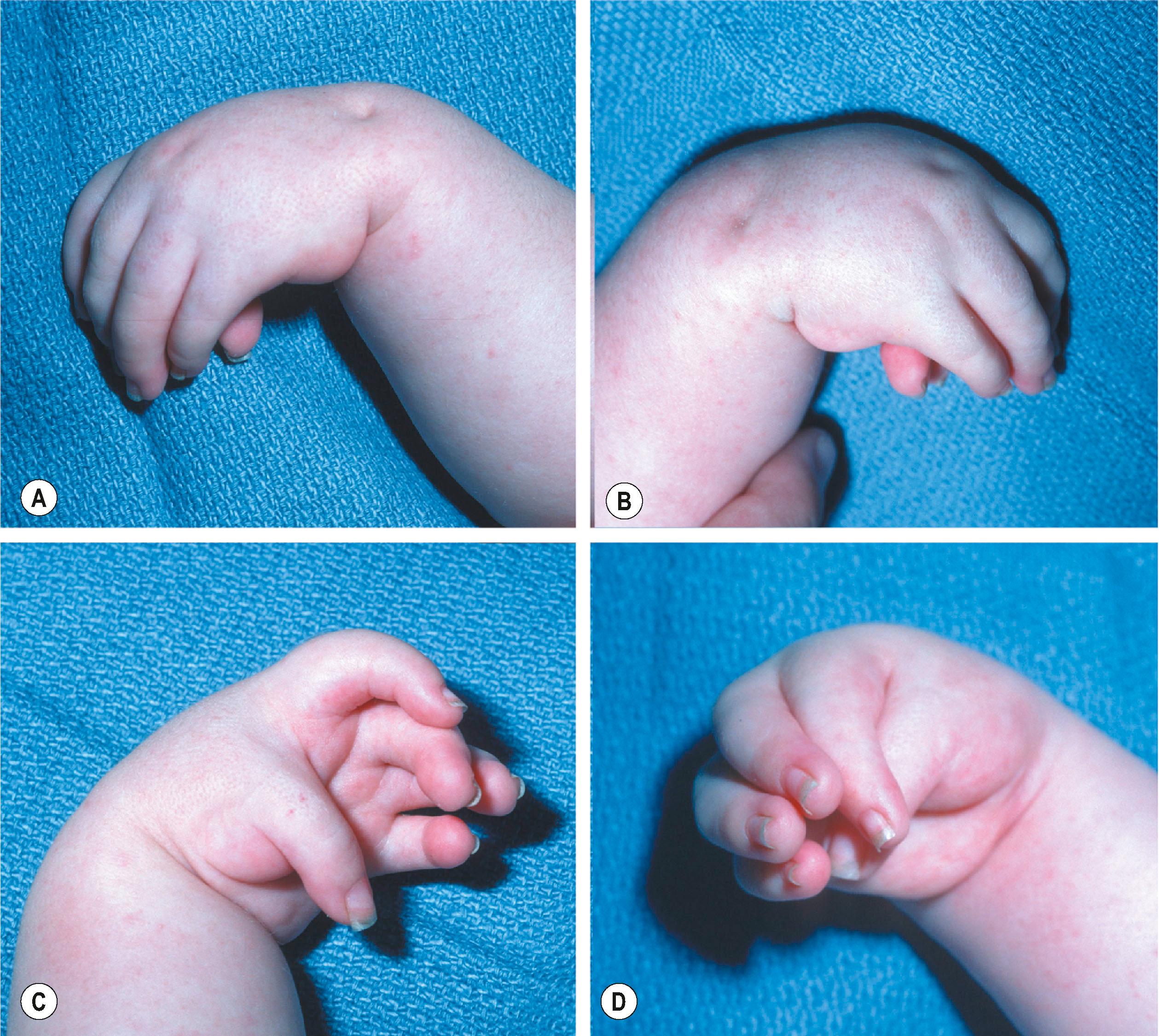 Figure 38.1, Classic hand and wrist contractures seen in amyoplasia with a flexed and ulnarly deviated wrist (A,B) and flexed fingers with a thumb-in-palm deformity (C,D) .