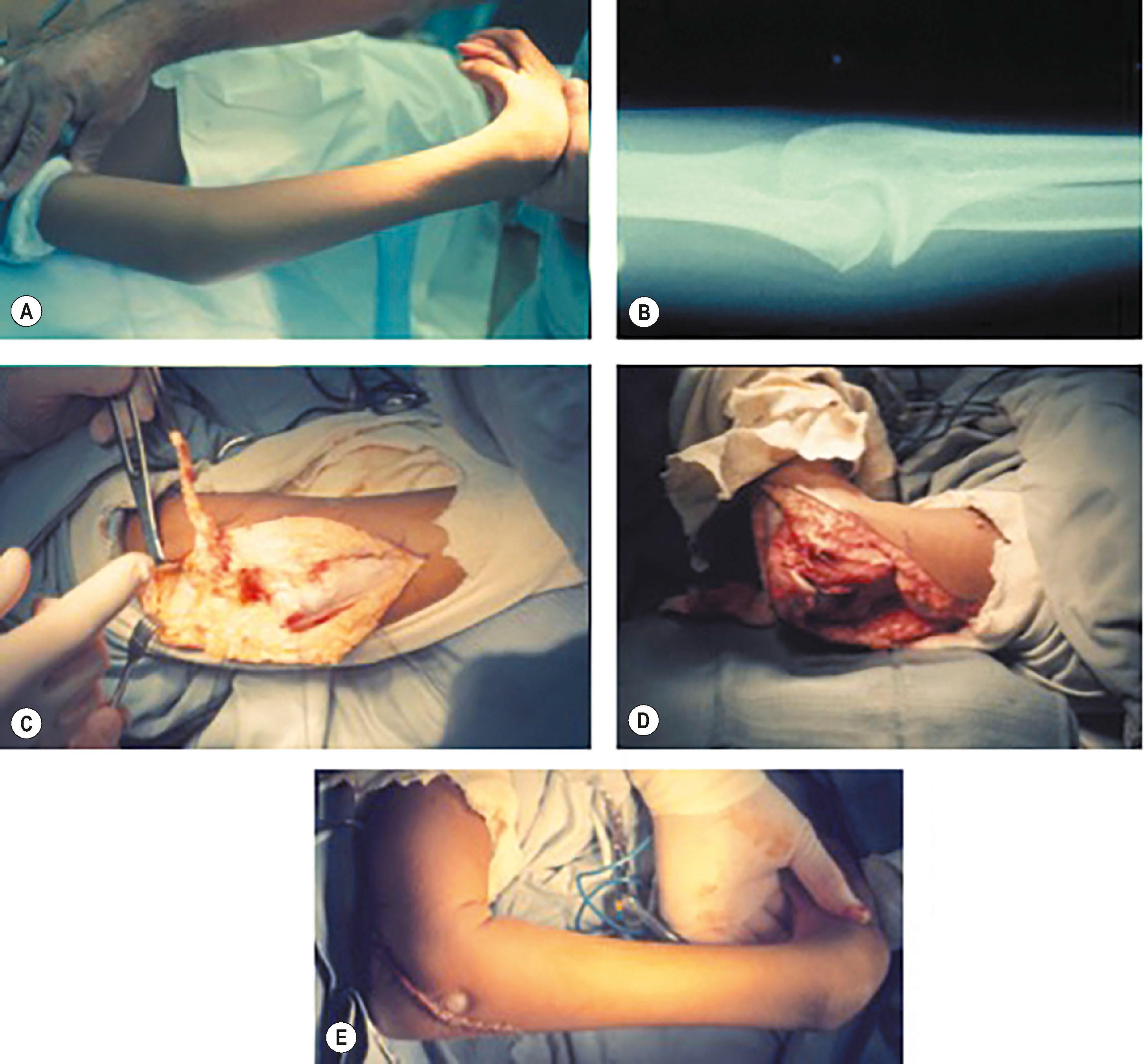 Figure 38.2, Arthrogryposis patient with elbow extension contracture and weak active flexion. (A) Preoperative maximal passive flexion. (B) Preoperative elbow radiograph. (C) Release of tight triceps with dissection of long head of triceps for transfer. (D) Improved passive flexion after posterior capsulotomy. (E) Passive flexion after transfer of long head of triceps to proximal ulna using bone tunnel and transcutaneous suture through external dental swab prior to availability of suture anchors.