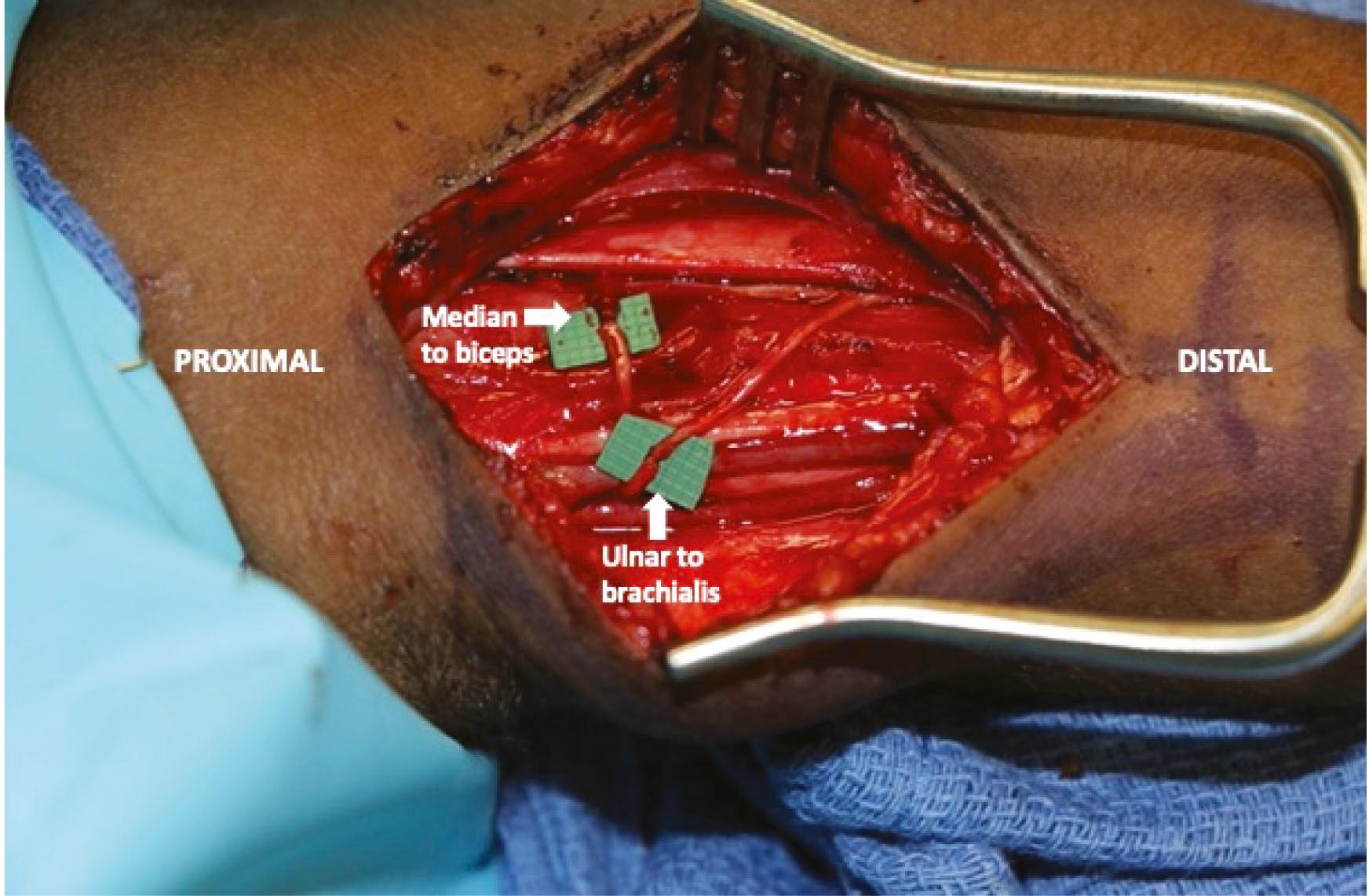 Figure 38.3, Double Oberlin transfer with ulnar nerve fascicle transferred to brachialis motor branch and median nerve fascicle to the biceps motor branch.