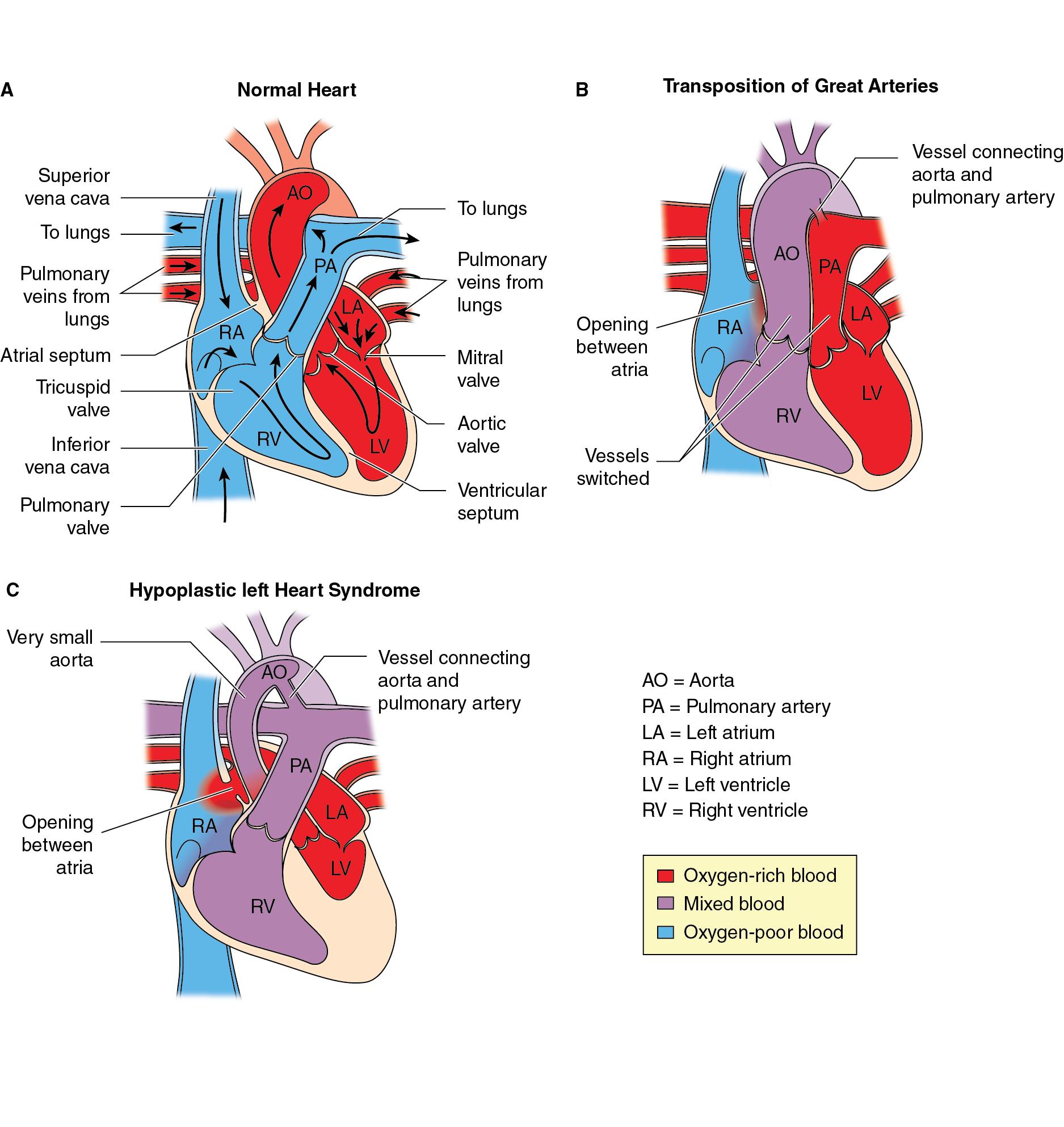 Fig. 16.2, Anatomic images of a (A) normal heart, (B) transposition of the great arteries, and (C) hypoplastic left heart syndrome.