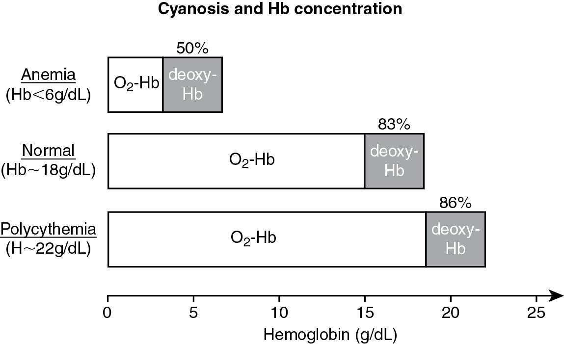 Fig. 16.5, Effect of hemoglobin concentration and cyanosis. Hb, Hemoglobin; O 2 -Hb, oxyhemoglobin.