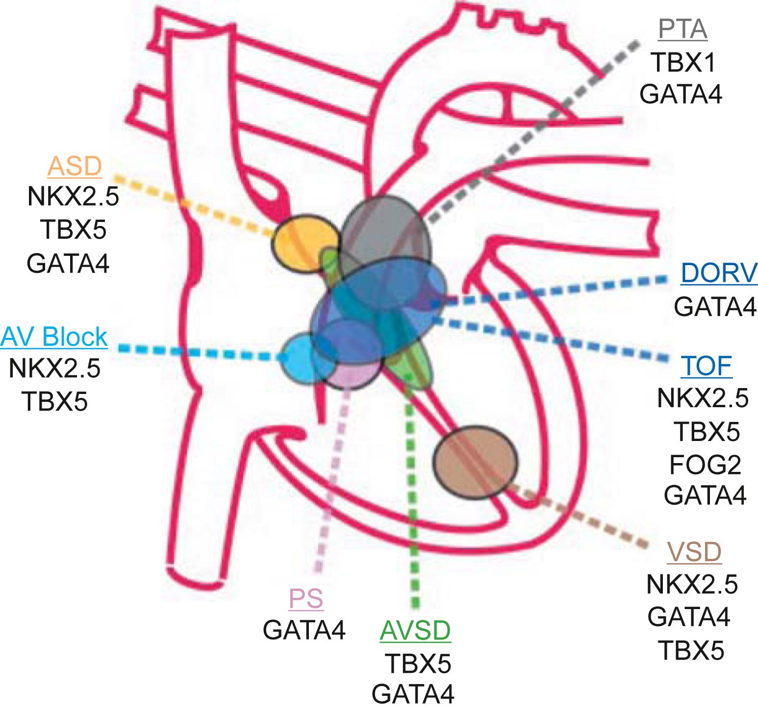 Figure 6.2, Sites of some of the major structural congenital heart disease (CHDs). Note how the same transcription factor is linked to multiple anomalies and how each anomaly can be caused by more than one gene. ASD , Atrial septal defect; AV block , atrioventricular block; AVSD , atrioventricular septal defect; DORV , double outlet right ventricle; PS , pulmonary stenosis; PTA , tricuspid atresia; TOF , tetralogy of Fallot; VSD , ventricular septal defect.