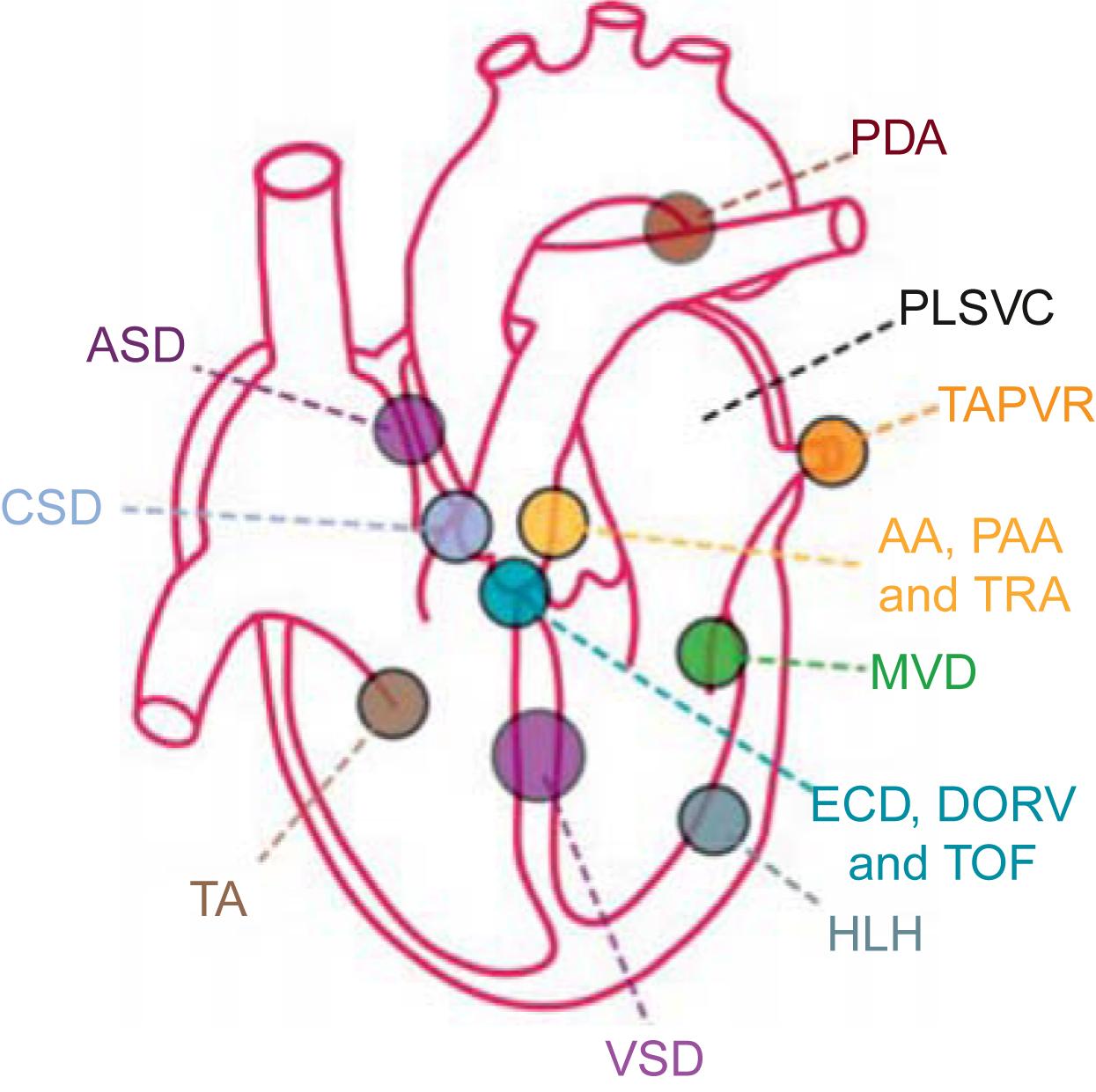 Figure 6.3, Multiple cardiac anomalies associated with Holt–Oram syndrome (HOS). ASDs and CSDs are the most frequent. AA , Aortic atresia; ASD , atrial septal defect; CSD , conduction system defect; DORV , double outlet right ventricle; ECD , endocardium cushion defect; HLH , hypoplastic left heart; MVD , mitral valve defect; PAA , pulmonary artery atresia; PDA , patent doctus arteriosis; PLSVC , persistent left superior vena cava; TA , tricuspid atresia; TAPVR , total anomalous pulmonary venous return; TOF , tetralogy of Fallot; TRA , truncus arteriosus; VSD , ventricular septal defect.