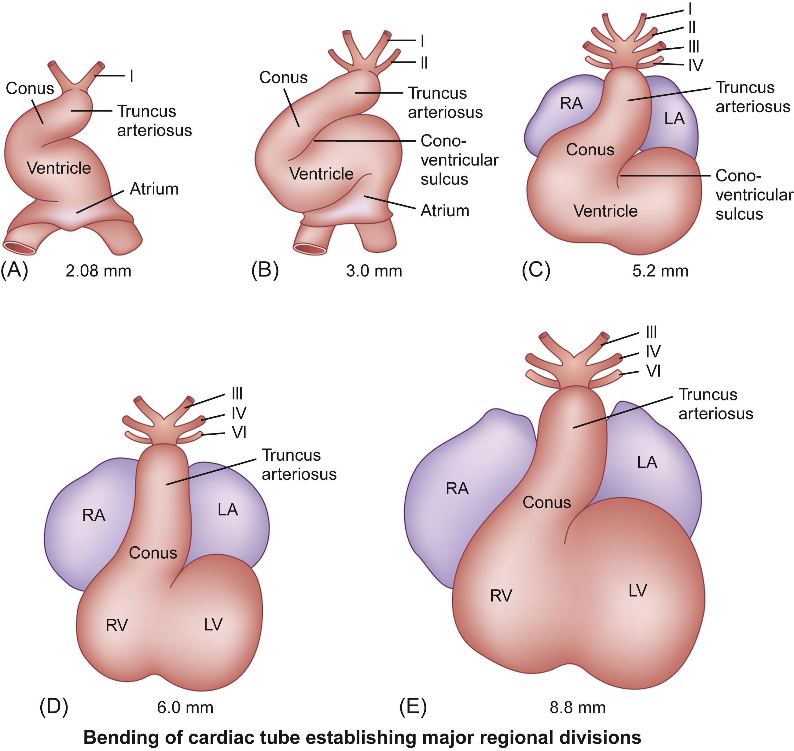 Figure 6.4, Cardiac embryogenesis from day 23 to 35: Ventral view of the human embryonic heart showing bending of the cardiac tube and establishing major regional divisions. (A) The single chambered heart initially is a straight tube positioned in the pericardial cavity that generates unidirectional blood flow from the caudal/venous pole to the cranial/arterial pole. (B) The bulboventricular region grows much more rapidly than the pericardial cavity. As a result, further extension in a longitudinal direction is blocked, and the heart tube is forced to bend. (C, D, and E) The cephalic ventricular component of the tube bends in a ventral and caudal direction and to the right, while the caudal atrial component moves in a dorsal and cranial direction and to the left. This process is known as dextro ( d ) -bulboventricular looping , and it results in the atrial region developing a position superior to the ventricular region and the cardiac apex pointing to the left. I, II, III, IV, VI refer to aortic arches; millimeters (mm) refer to the human embryo’s crown-rump length. LA , Left atrium; LV , left ventricle; RA , right atrium; RV , right ventricle.