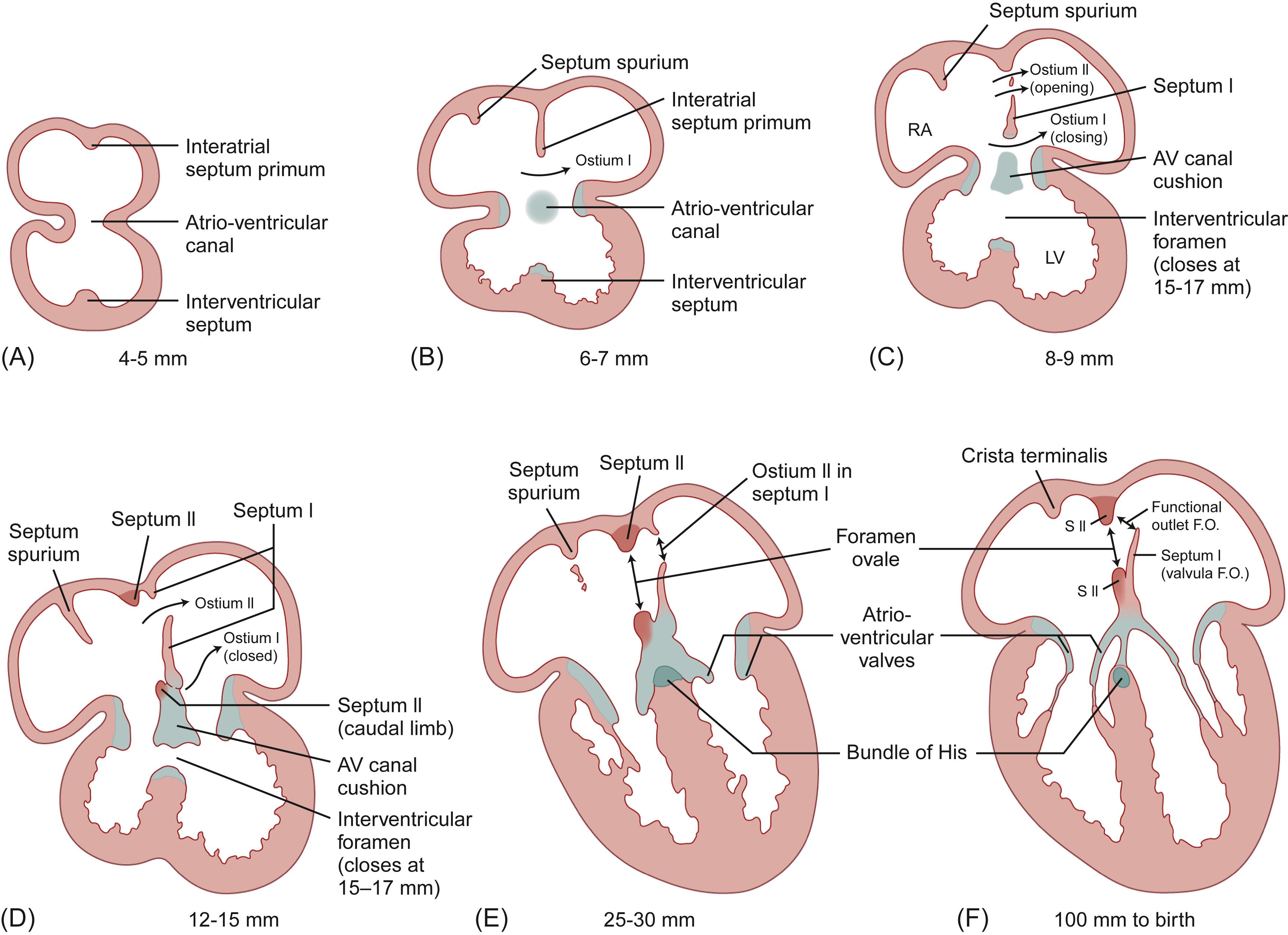 Figure 6.5, Frontal longitudinal sections of human embryonic heart show the growth of cardiac septa at progressive partitioning stages of development. Millimeters (mm) refer to the human embryo’s crown-rump length. (A) By day 28, the atrioventricular canal septation begins. The atrial region forms a large cavity dorsal posterior to the ventricular region and starts to divide into the right and left atria. At this stage, the ventricle is bounded ventrally by the bulbus cordis and the atria dorsally. (B) Septum primum grows toward endocardial cushions, narrowing ostium primum . (C) Ostium secundum forms in septum primum , while ostium primum disappears. (D) Septum secundum develops and ostium secundum maintains right-to-left blood shunt during intrauterine development. (E) S eptum secundum continues to enlarge leaving a small opening, the foramen ovale , that is, in continuum with the ostium secundum , again allowing right-to-left shunt. (F) By end of week 5, septum secundum expands and covers most of the ostium secundum , and the septum primum diminishes. Eventually, the septum primum is a small flap that covers the foramen ovale on its left side, called the valve of the foramen ovale . This valve opens and closes in response to pressure gradients between the left and right atria. The valve opens when the pressure is greater in the right atrium, and closes when the pressure is greater in the left atrium.