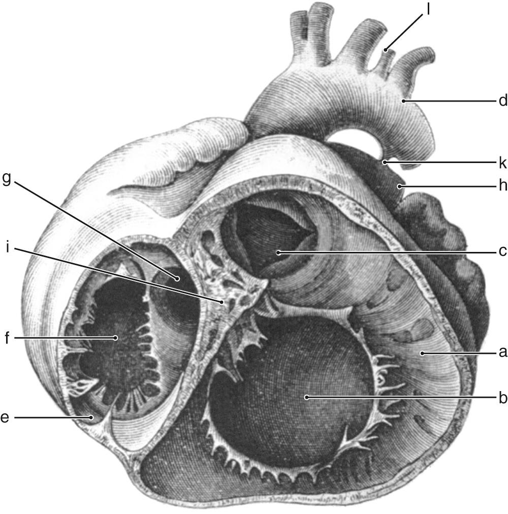 Fig. 38.1, The illustration made by von Rokitansky shows the short axis of the heart viewed from the aspect of the cardiac apex. The locations of the cardiac valves are indicative of congenitally corrected transposition.