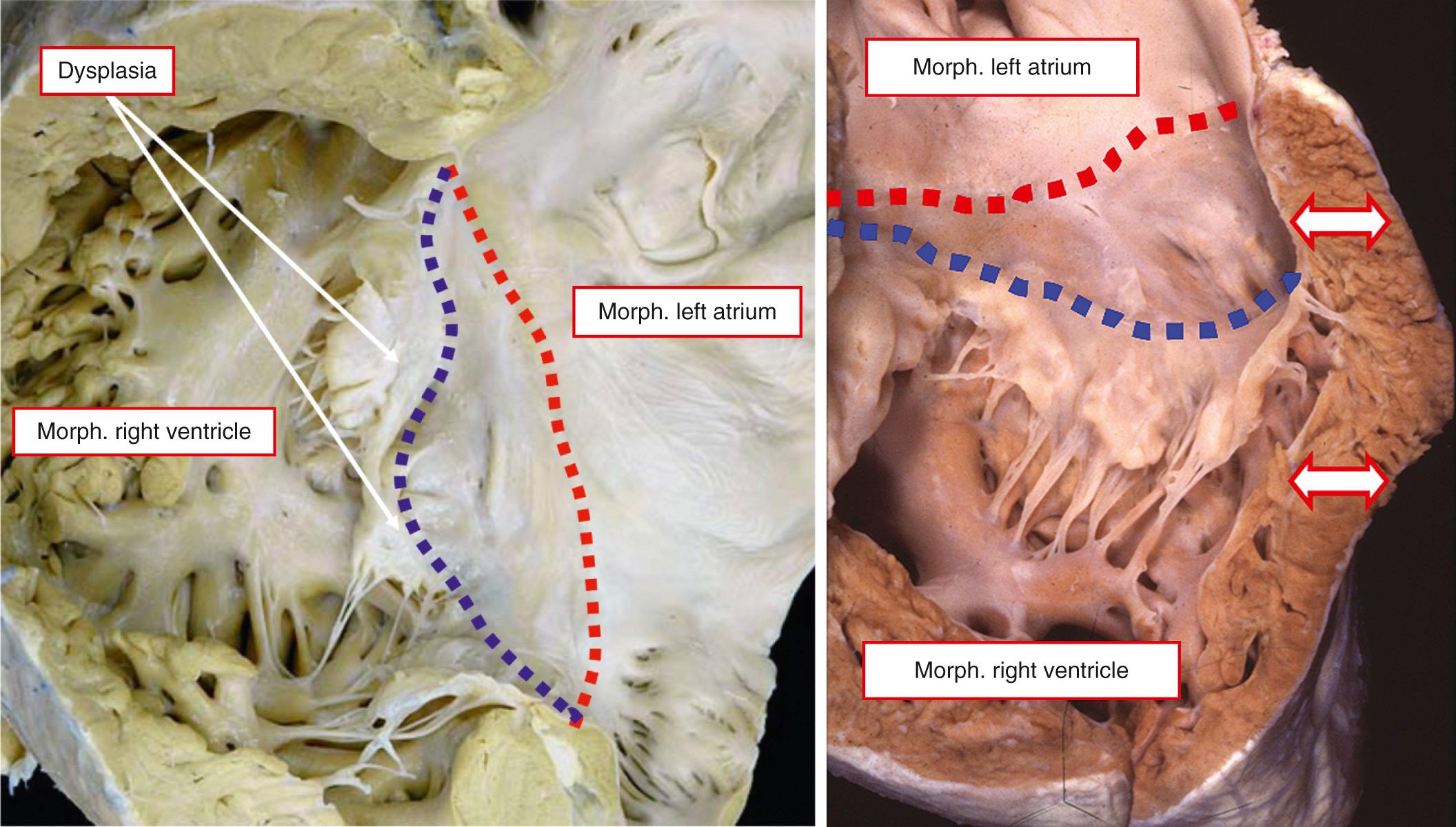 Fig. 38.11, Typical arrangement of Ebstein malformation of the morphologically (morph.) tricuspid valve as seen in the setting of congenitally corrected transposition. The hinge line of the septal leaflet (blue dotted line) is rotated away from the atrioventricular junction (red dotted line) but in the absence of any thinning of the myocardium of the ventricular inlet (arrows) . Note the additional dysplasia of the valvar leaflets.