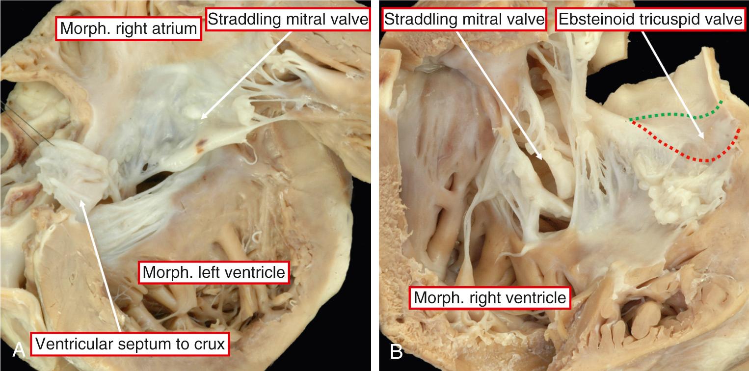 Fig. 38.12, Features of overriding and straddling of the mitral valve in the setting of discordant atrioventricular connections. (A) Ventricular septum still inserted at the crux. (B) How the valve straddles to the outlet of the morphologically (Morph.) right ventricle, with this heart also having double outlet from the right ventricle. Note also the ebsteinoid malformation of the morphologically tricuspid valve.