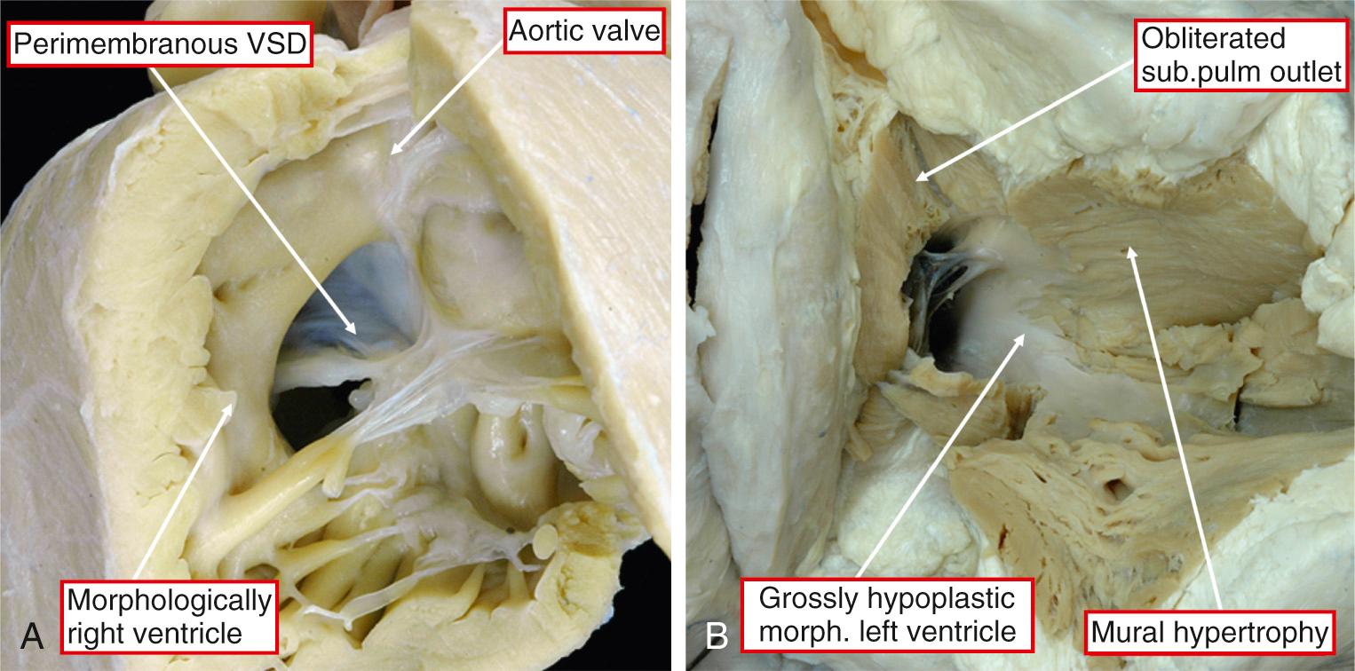 Fig. 38.13, Pulmonary atresia seen in the setting of congenitally corrected transposition with a ventricular septal defect (A) or an intact ventricular septum (B). The heart in panel A is photographed from the morphologically right ventricle, showing the subaortic location of a large perimembranous defect. Panel B shows the grossly hypoplastic left ventricle found when the septum is intact. VSD, Ventricular septal defect.