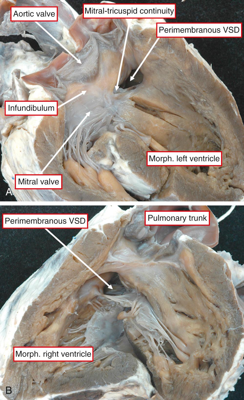 Fig. 38.14, Features of discordant atrioventricular connections combined with concordant ventriculoarterial connections. (A) Right-sided and (B) left-sided chambers. VSD, Ventricular septal defect.