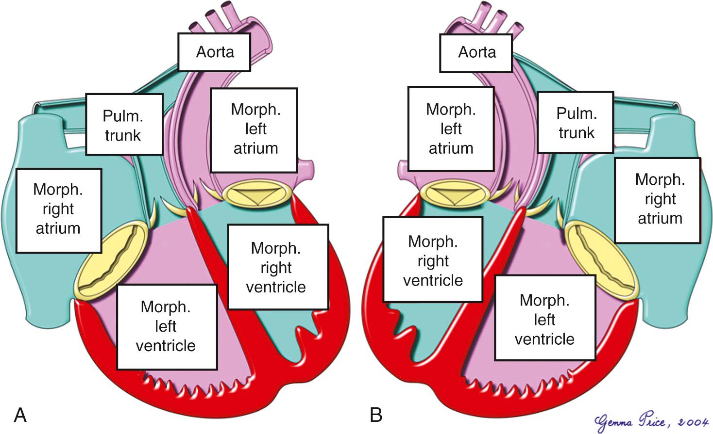 Fig. 38.2, Segmental arrangements producing congenitally corrected transposition, shown with usual atrial arrangement (A) and mirror-imaged atrial arrangement (B).