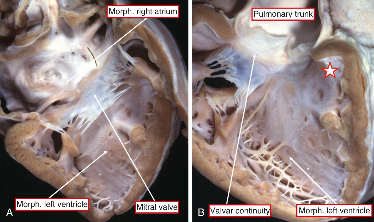 Fig. 38.3, Connections across the right-sided atrioventricular junction (A) and the right-sided ventriculoarterial junction (B) in a heart from a patient having congenitally corrected transposition with intact septal structures in the setting of usual atrial arrangement. The star shows the typical recess anterior to the outflow tract from the morphologically (morph.) left ventricle.