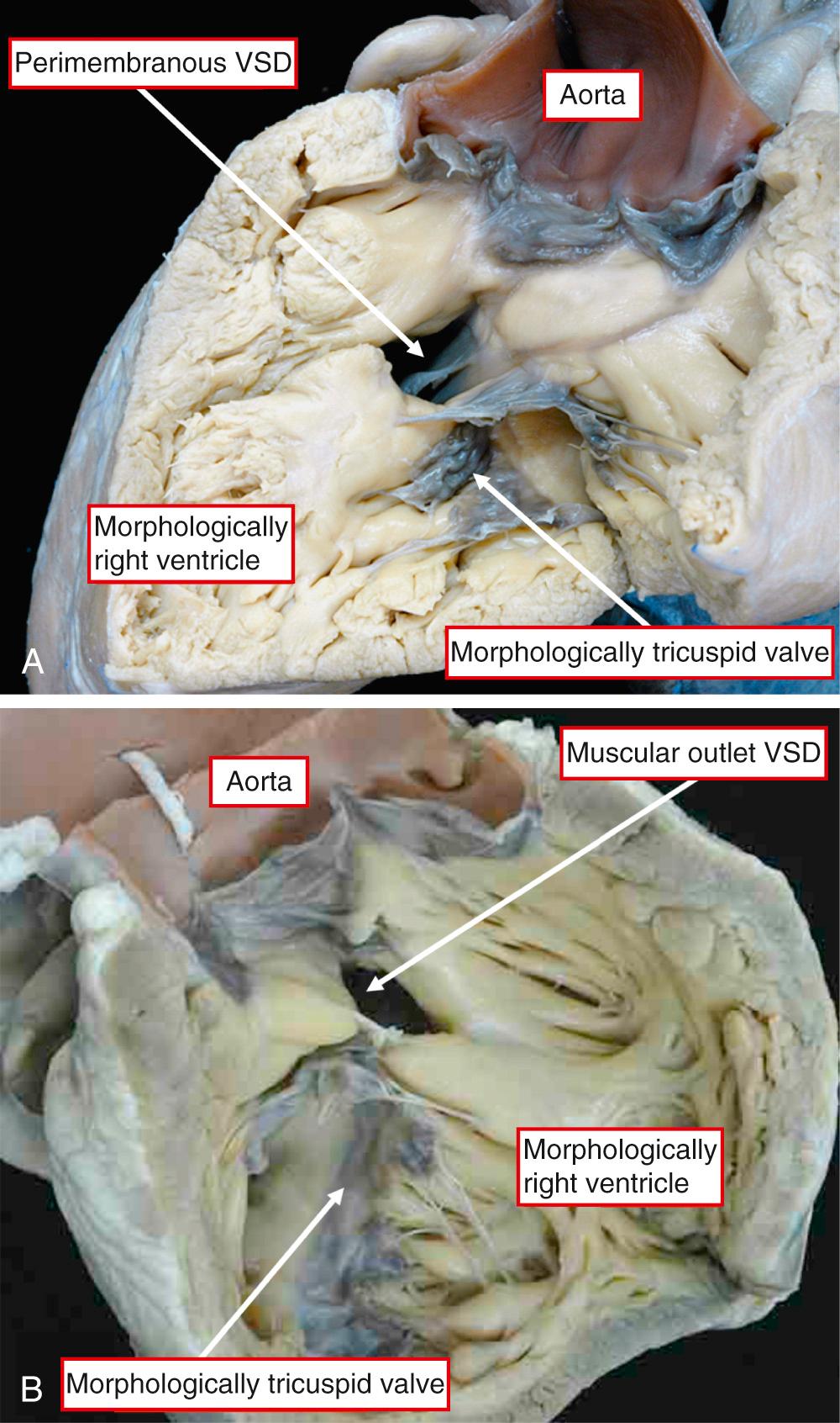 Fig. 38.4, Morphologically right ventricle from hearts obtained from patients with congenitally corrected transposition in the setting of usual atrial arrangement (A) and mirror-imaged arrangement (B). The ventricular mass is itself mirror-imaged, showing left-sided topology, when the atrial chambers are usually arranged (A). In contrast, the ventricular mass shows the normal right-sided topologic arrangement when the atrial chambers are mirror-imaged (B). The aorta arises from the ventricular mass in right-sided and anterior position. Both hearts have deficient ventricular septation. VSD, Ventricular septal defect.