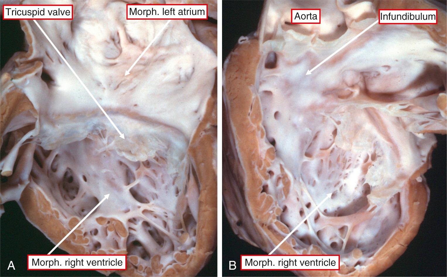 Fig. 38.5, Left-sided chambers in a heart from a patient with congenitally corrected transposition in the setting of usual atrial arrangement. (A) Discordant atrioventricular and (B) discordant ventriculoarterial connections. Note the completely muscular subaortic infundibulum and the left-sided ventricular topology.