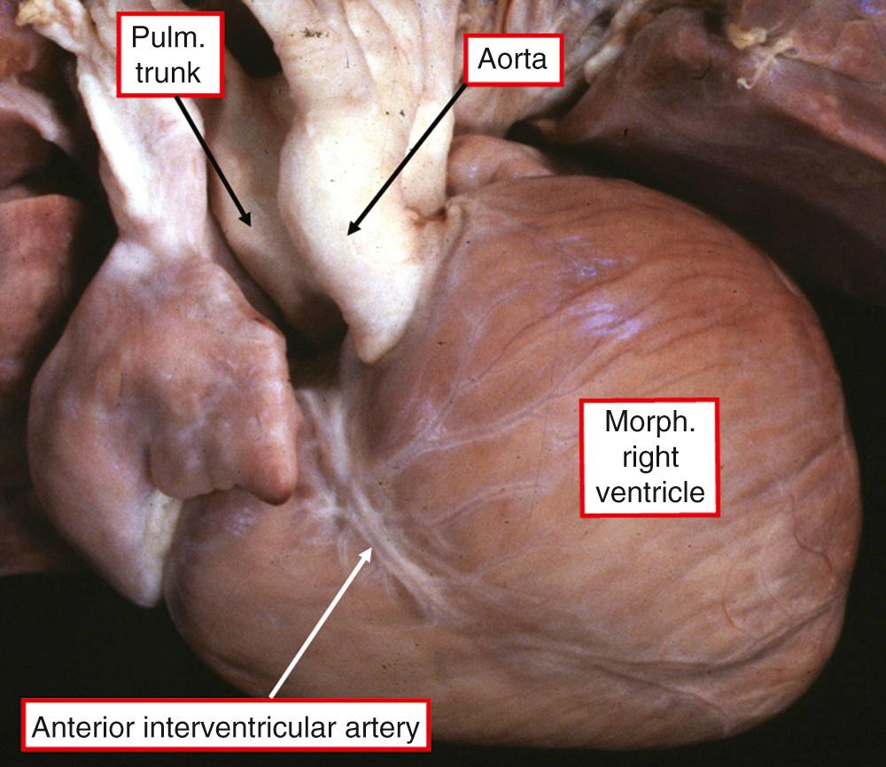 Fig. 38.6, Anterior and left-sided aorta that is a typical finding in hearts from patients with congenitally corrected transposition and usual atrial arrangement. However, when found in the setting of mirror-imaged atrial chambers, it is usual for the aorta to be anterior and right sided (see Fig. 38.4B ).