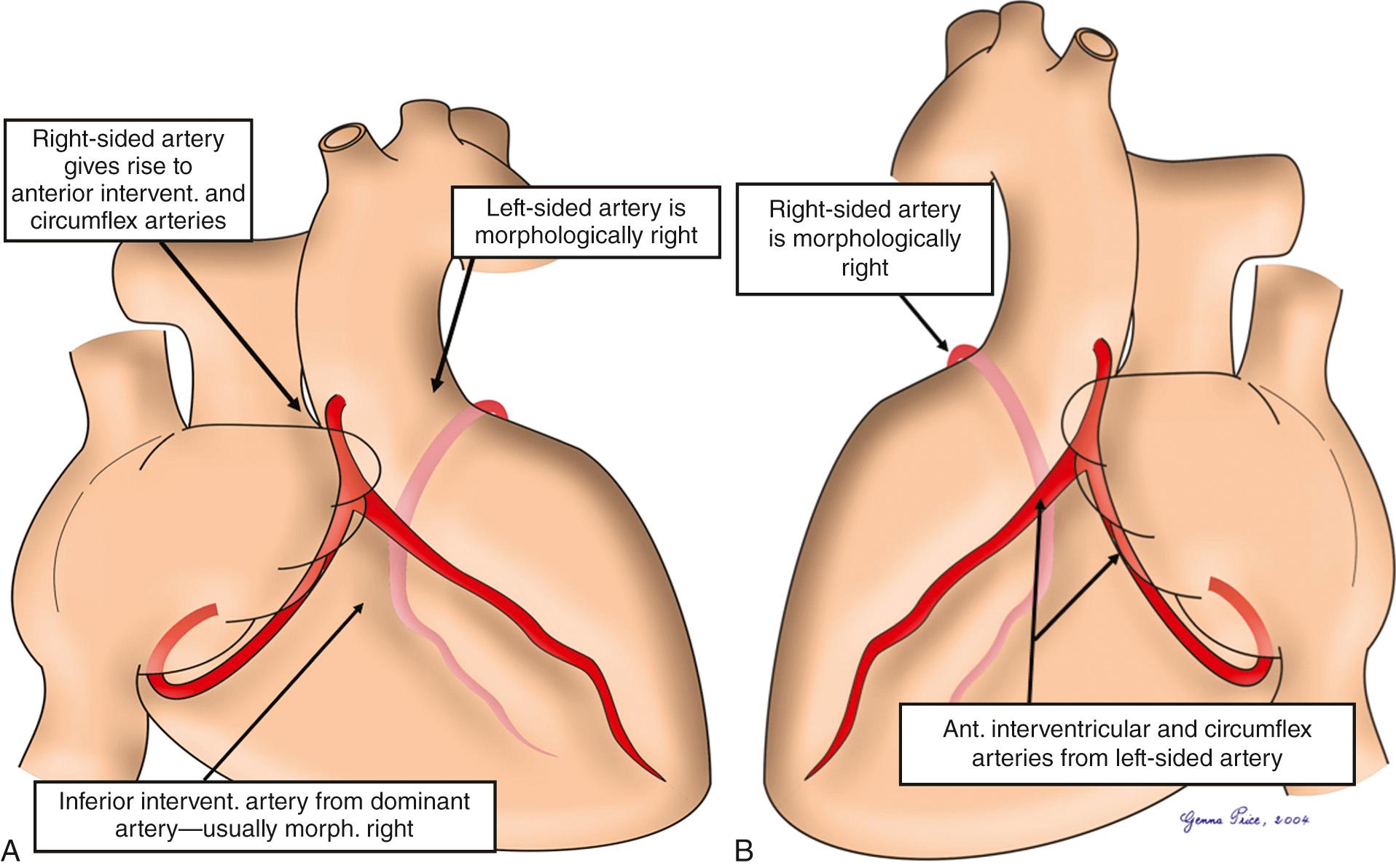 Fig. 38.7, Epicardial distribution of the coronary arteries in patients with congenitally corrected transposition reflecting the ventricular topology. Thus, in the usual situation, with left-sided topology (A), the morphologically (morph.) left coronary artery is right sided, with the morphologically right coronary artery being left sided. The situation is mirror-imaged in the setting of right-sided topology (B), so that the arrangement is as seen in the normal heart. intervent. , Interventricular.