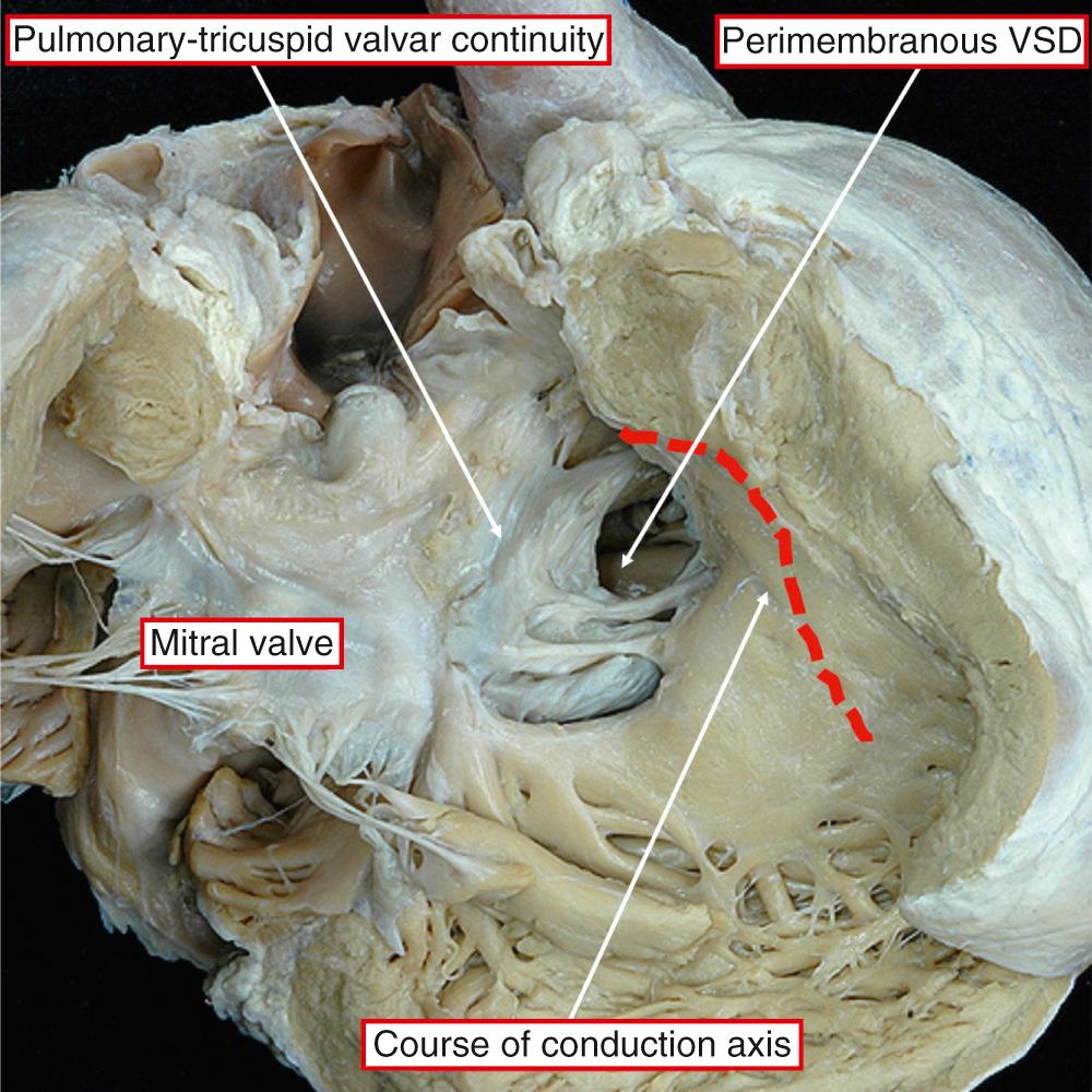 Fig. 38.9, Perimembranous defect in a heart with congenitally corrected transposition and usual atrial arrangement. The conduction axis runs anterocephalad relative to the margins of the defect. VSD, Ventricular septal defect.