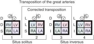 Figure 55-1, Diagrammatic models of the four basic hearts (see Appendix 1H in Chapter 1 ) as they occur in transposition of the great arteries (ventriculoarterial discordant connection), with most common great arterial positions indicated. Degree of elevation of great arteries above their respective ventricles corresponds to usual type of conal development. Models 1 and 4 are complete transposition of the great arteries, and models 2 and 3 are congenitally corrected transposition of the great arteries. Key: LA, Left atrium; LV, left ventricle; RA, right atrium; RV, right ventricle.