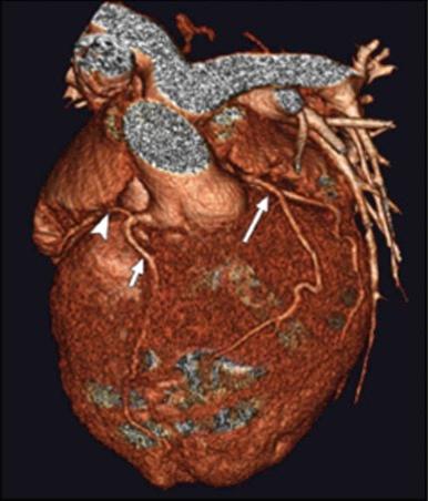 Figure 55-12, Three-dimensional volume-rendered computed tomography image shows spatial relationship of great arteries, with ascending aorta anterior and to left of pulmonary trunk. Anterior descending artery (short arrow) and circumflex artery (arrowhead) arise from common left anterior descending coronary artery off anterior aortic sinus. Right coronary artery (long arrow) arises from posterior aortic sinus.