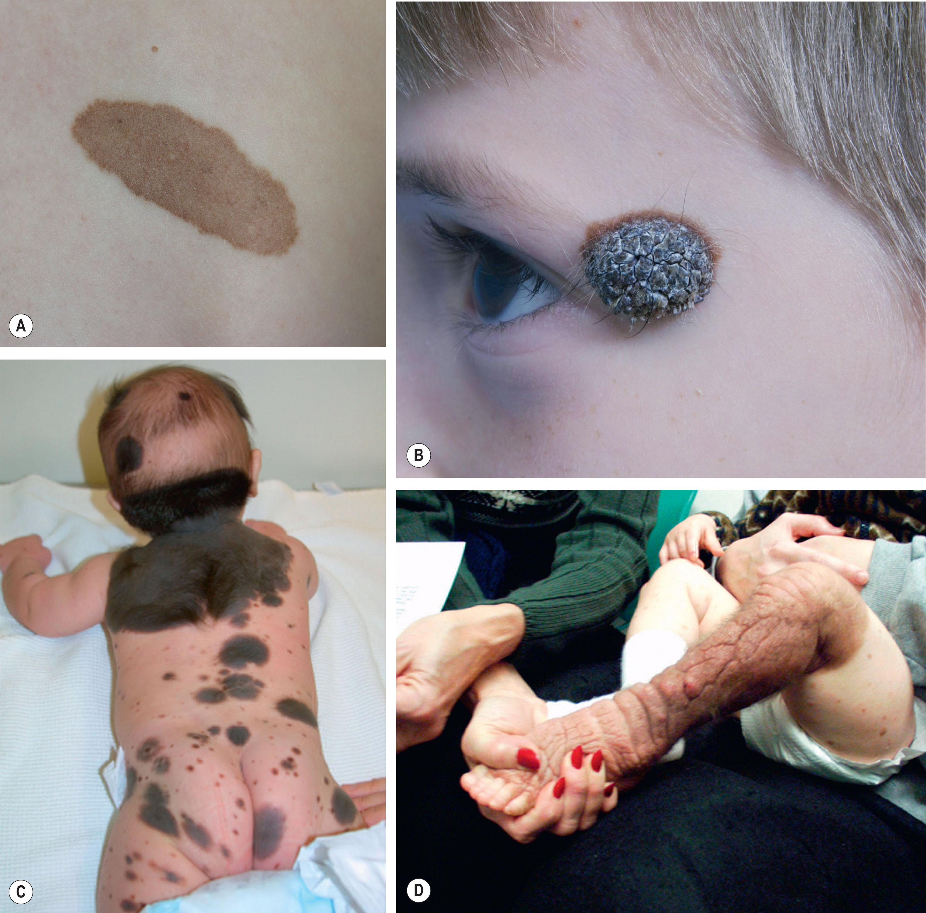 Figure 30.2, Nevi present with widely variable appearance and size. (A,B) Small and medium nevi may be flat with uniform color and border, or thick and verrucous. (C) They may present as large nevi with multiple small and medium satellite nevi, or (D) on the lower extremity they may become thick, cerebriform-like, and associated with severe pruritus and chronic breakdown.