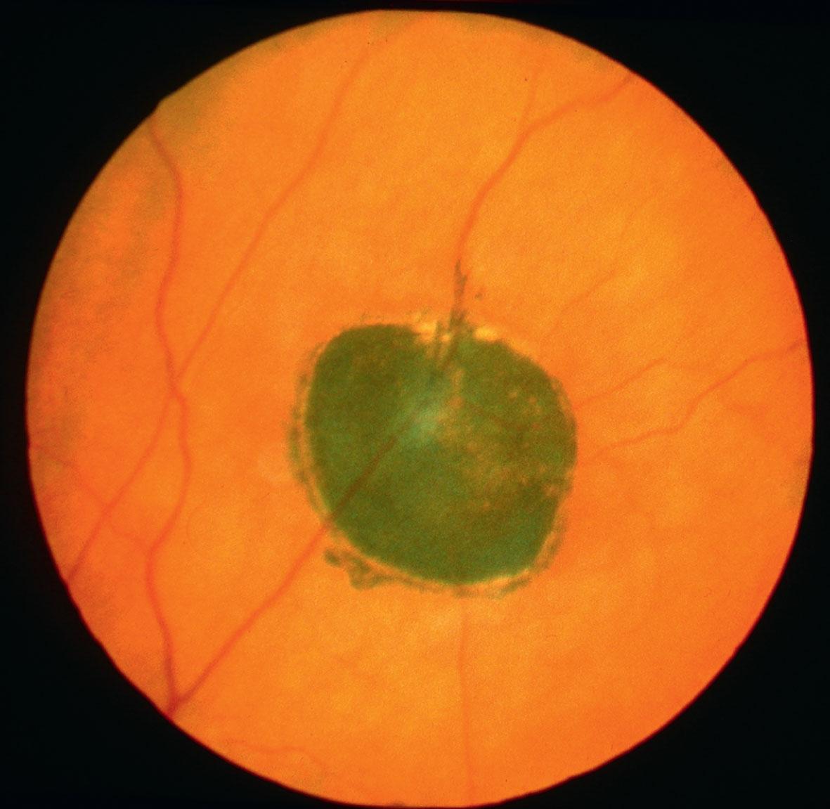 Fig. 48.1, Congenital hypertrophy of the retinal pigment epithelium (CHRPE). Slightly raised jet-black lesion in the mid-periphery with an associated small visual field defect. Patient of Professor A.C. Bird.