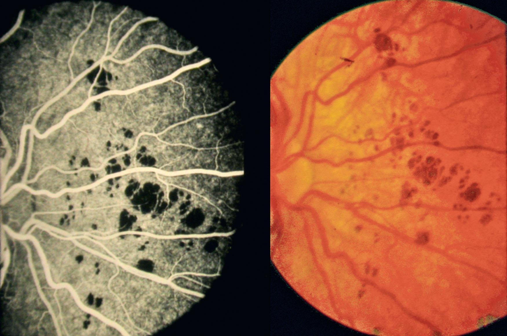 Fig. 48.3, Congenital grouped pigmentation (“bear track”). ( right ) Unilateral, multiple brown patches in the retinal pigment epithelium of no functional significance. Fluorescein angiography ( left ) shows masking of the underlying choroidal fluorescence. Patients of Professor A.C. Bird.