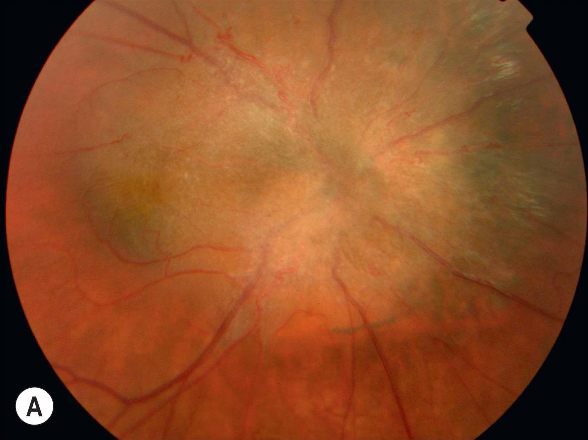 Fig. 48.4, Combined hamartoma of the retina and retinal pigment epithelium (CHRRPE). (A) Elevated, very slowly progressive right optic disc lesion presenting in a 6-year-old child with visual loss to 0.7 LogMAR at 11 years of age. Note the pigmentation, aneurysmal vessels, and pale “glial” tissue. (B) Fluorescein angiogram showing widespread telangiectatic vessels.