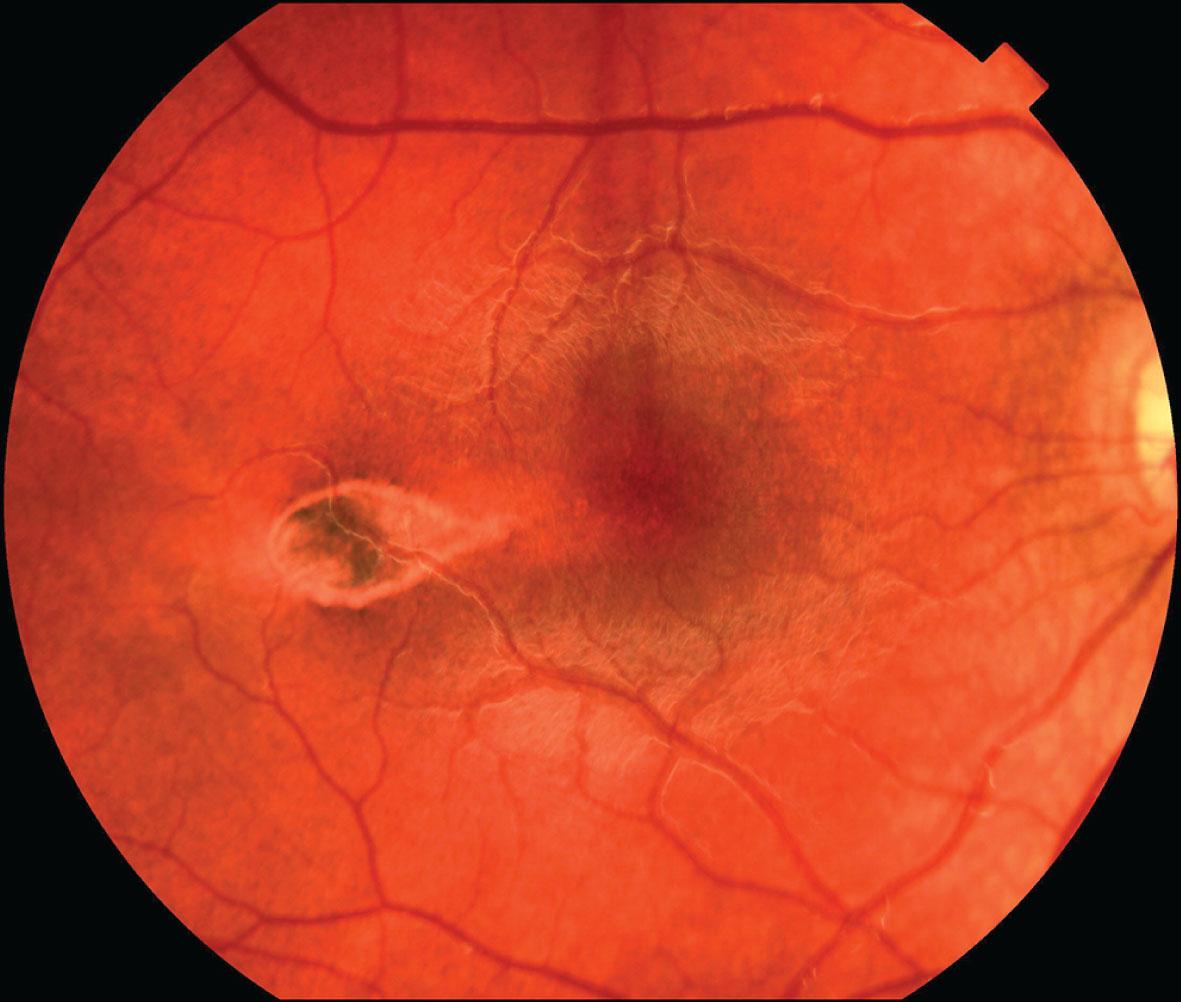 Fig. 48.5, “Torpedo” maculopathy. Sharply defined, non-pigmented lesion in the temporal region of the macula with a characteristic point aimed toward the fovea.