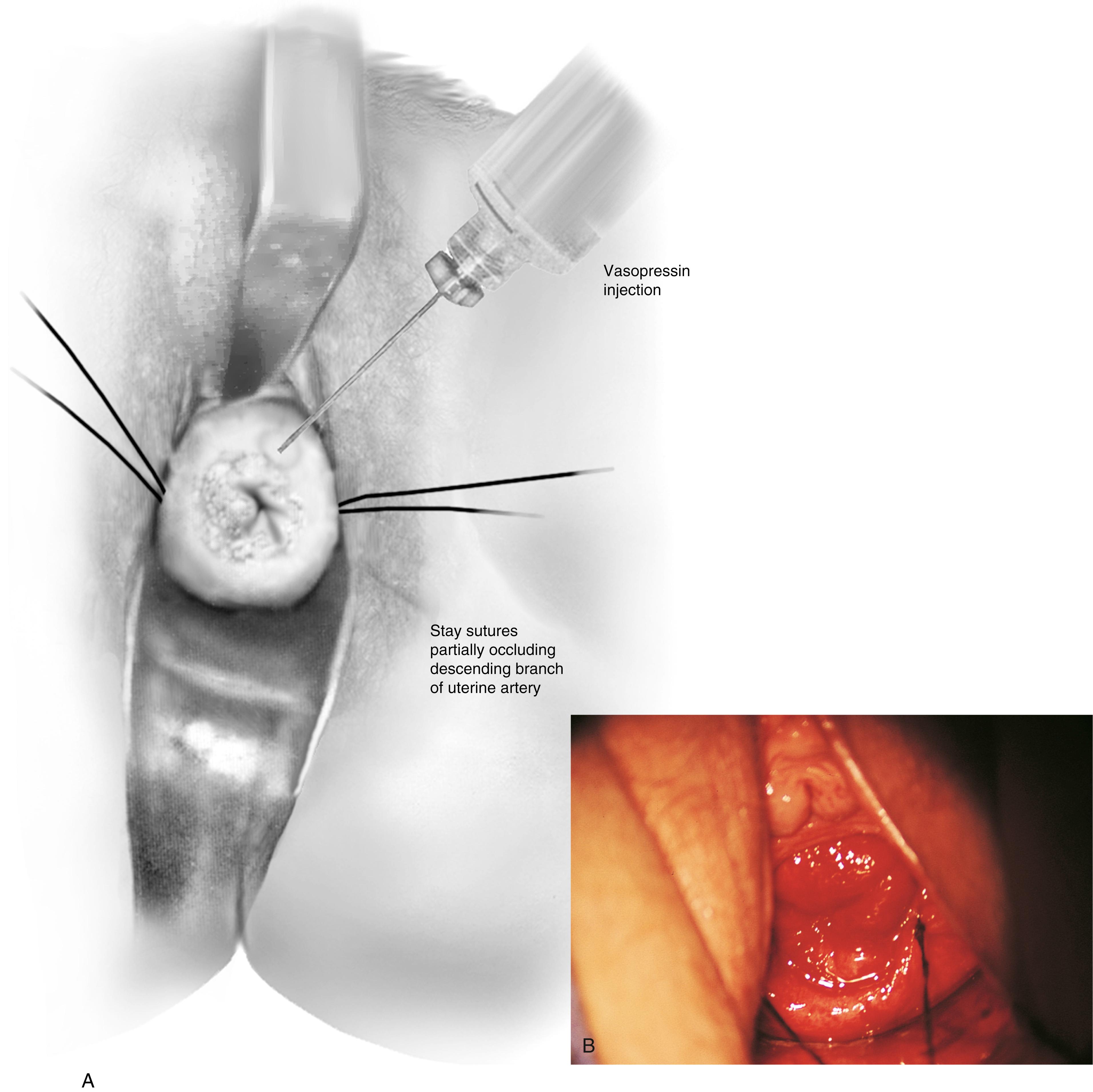 FIG. 44.1, A. Two sutures of 0 Vicryl have been placed into the lateral aspect of the cervix at the 9-o’clock and 3-o’clock locations. These are placed to diminish bleeding and to stabilize the cervix during surgery. B. The stay sutures are pulled downward to better expose the cervix. Even with a deep retractor placed posteriorly, the vagina bulges beneath the posterior cervix.