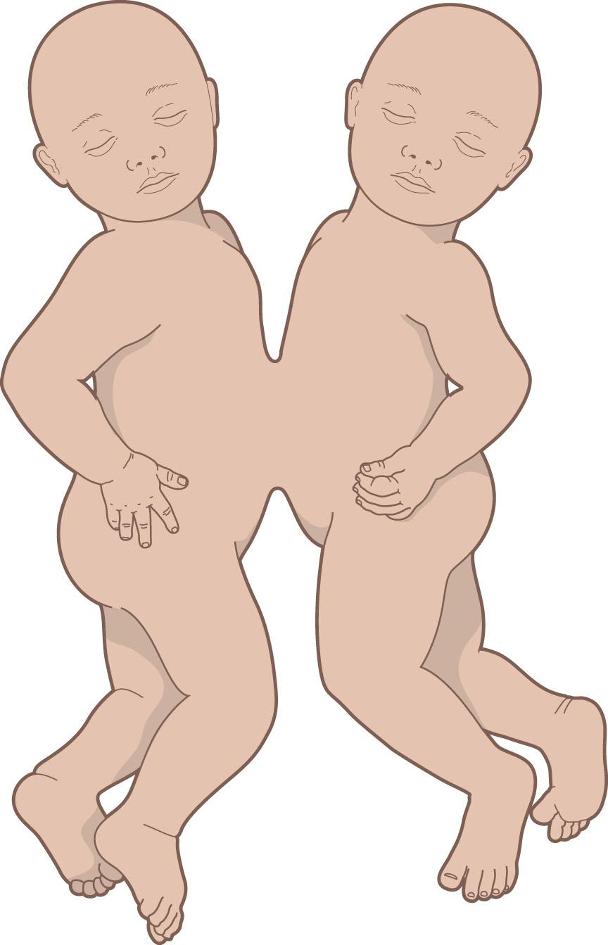 Figure 34.3, Omphalopagus twins.