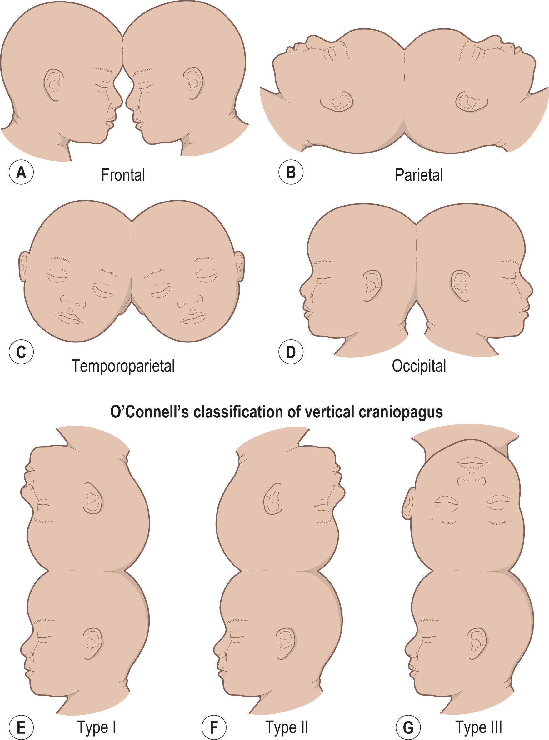 Figure 34.8, Craniopagus twins may be categorized by the location of calvarial fusion (A–D) , by their position relative to each other (E–G) , by the structures involved in the fusion, or by the configuration of the fusion.