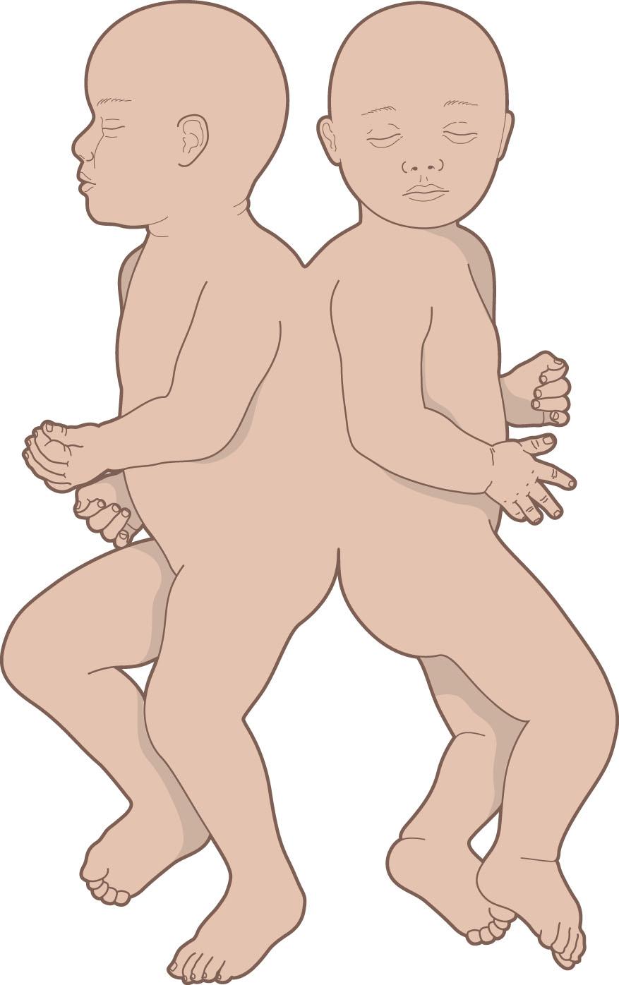 Figure 34.9, Rachipagus twins.