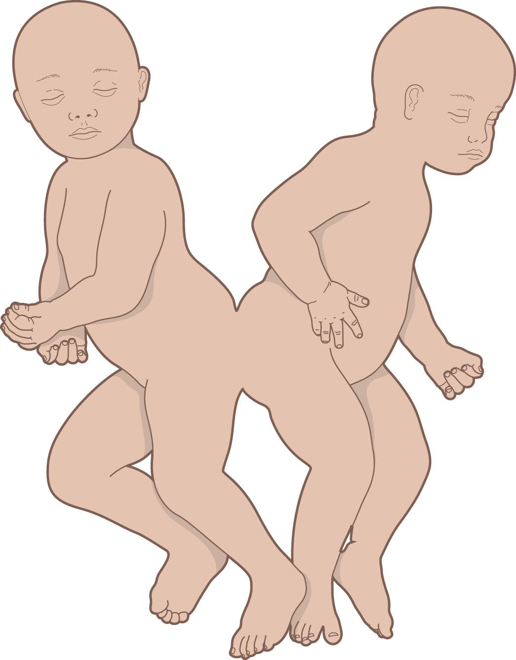 Figure 34.10, Pyopagus twins.