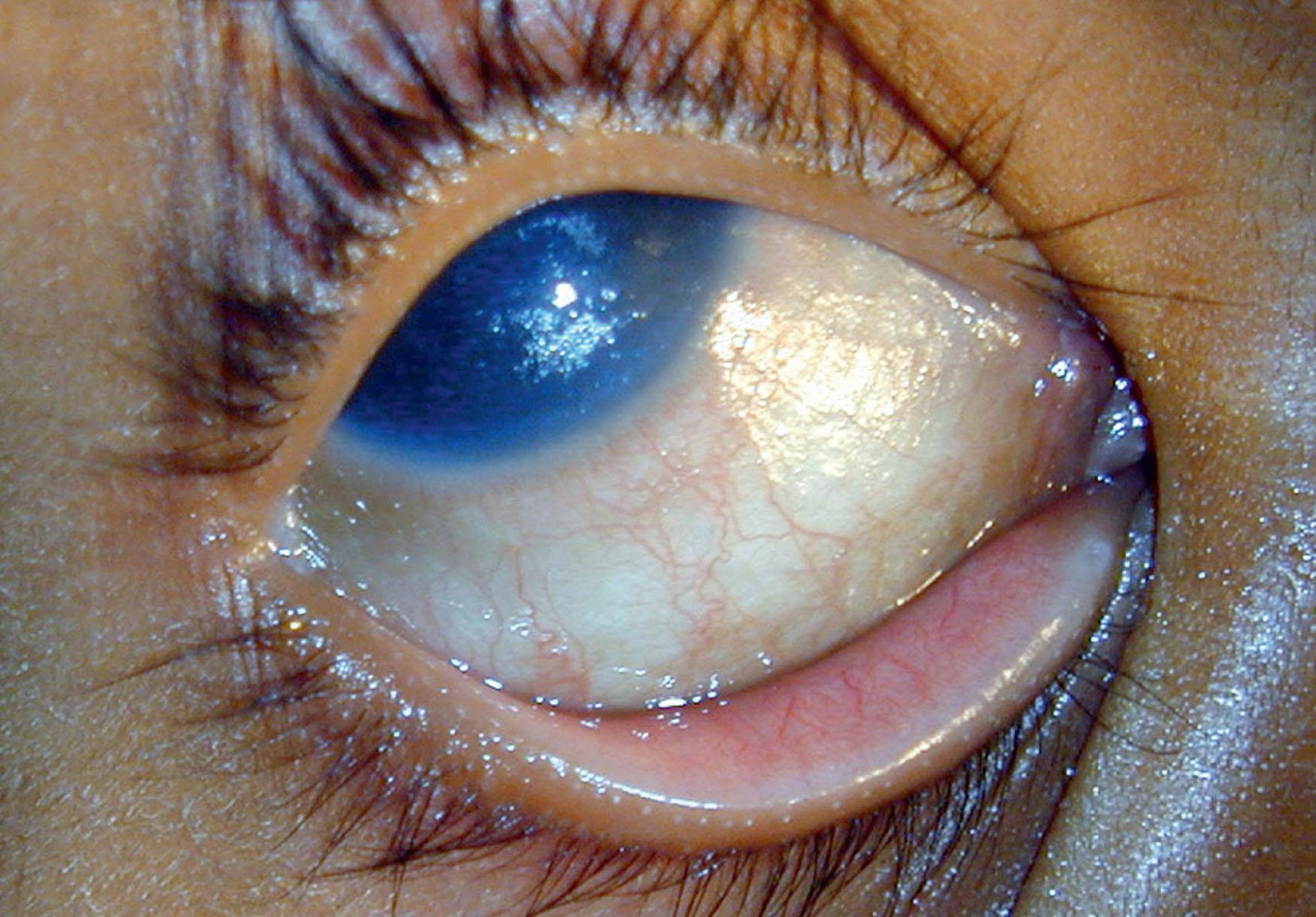 Fig. 29.1, Xerophthalmia. Dry, lusterless, inferior bulbar conjunctiva showing a wrinkled appearance. Associated corneal xerosis is also seen.