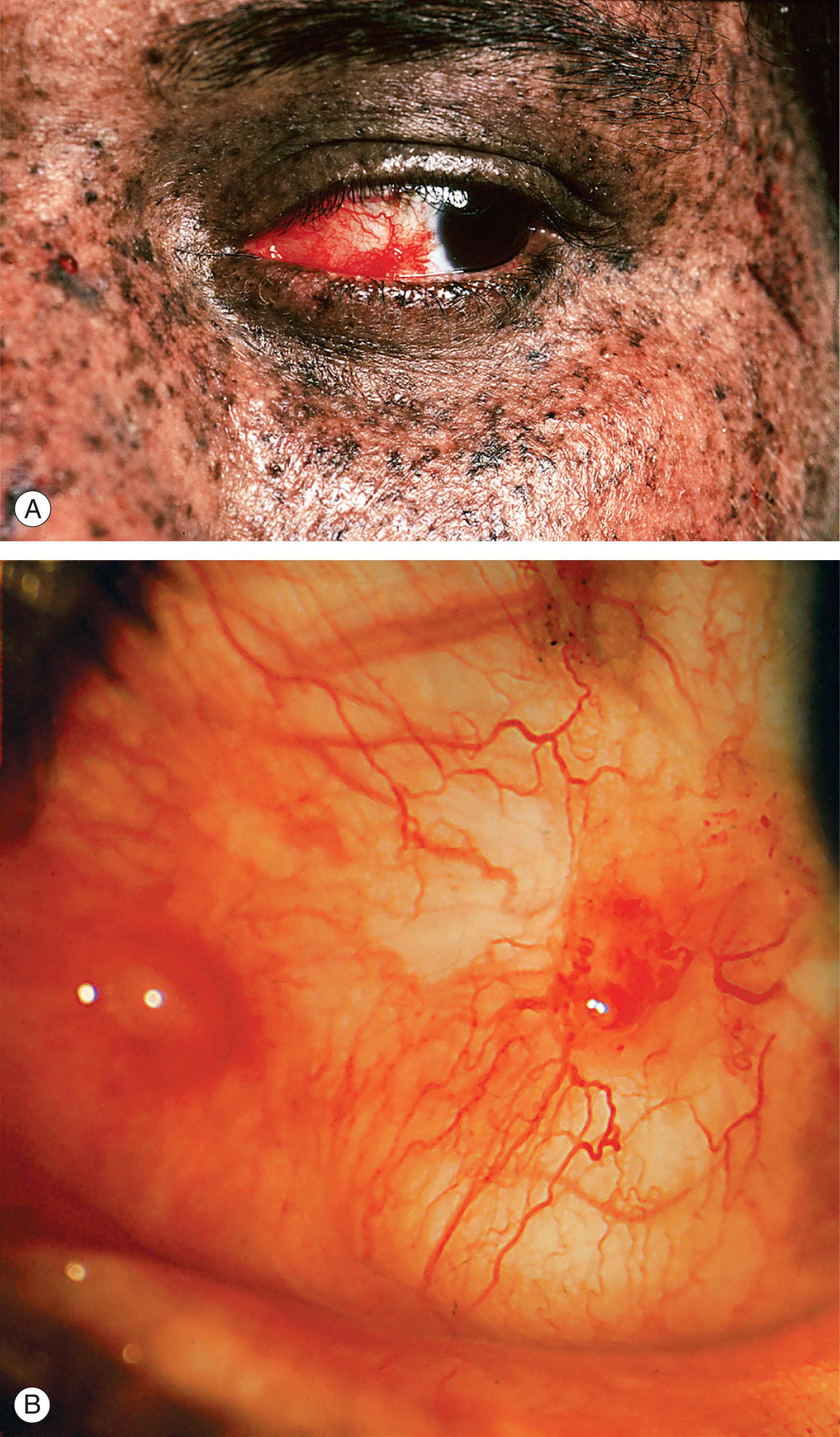 Fig. 29.3, Xeroderma pigmentosum. (A) The widespread skin pigmentation can be seen in this girl of Indian origin. (B) The conjunctiva was affected by multifocal recurrent squamous cell carcinomas.