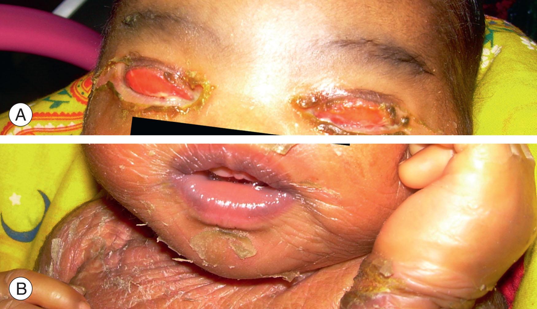 Fig. 29.4, Ichthyosis. (A) There is keratinization of the upper palpebral conjunctiva secondary to ectropion of the upper lids. (B) The classical “stretched out” skin lesions are seen predominantly around the mouth and neck.
