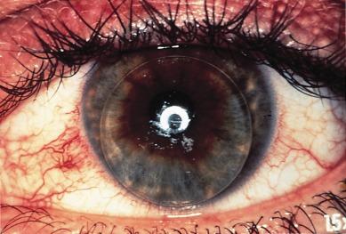 Fig. 13.2, Localised 3 & 9 o’clock bulbar conjunctival redness and circumlimbal redness in a rigid lens wearer.