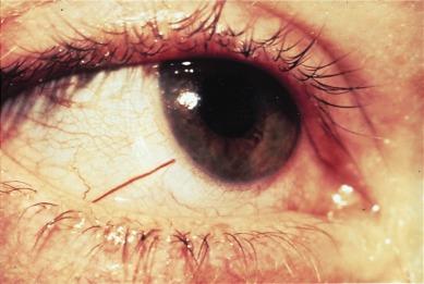 Fig. 13.3, Single distended conjunctival vessel presumed to be caused by blockage at the limbus.