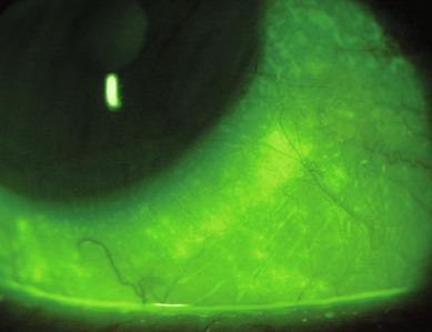 Fig. 11.3, Bright patch of fluorescent ‘pseudo-staining’ on the conjunctiva corresponding to the location of physical application of a fluorescein-impregnated paper strip to the globe.