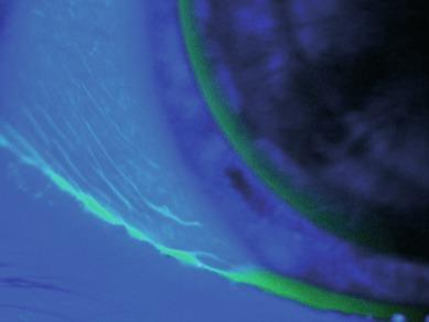 Fig. 11.4, Normal conjunctival furrow staining in a rigid lens wearer. The fine arcuate lines of ‘staining’ are because of pooling of fluorescein in normal conjunctival folds and are unrelated to lens wear.