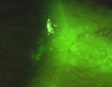 Fig. 11.5, Stipple staining beneath and outside a soft contact lens. The staining in the proximity of the lens edge is more confluent.